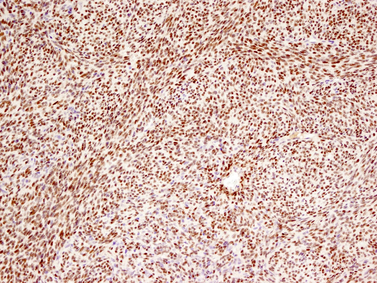 Monophasic synovial sarcoma, TLE1