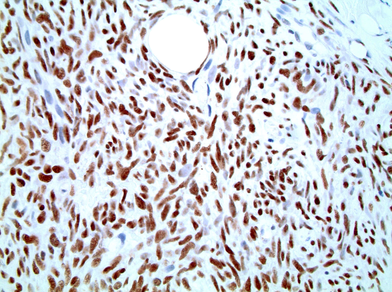 Monophasic synovial sarcoma, TLE1 positive