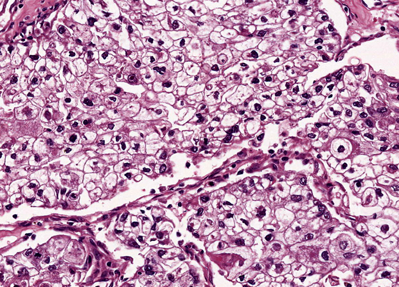 Clear cell renal cell carcinoma