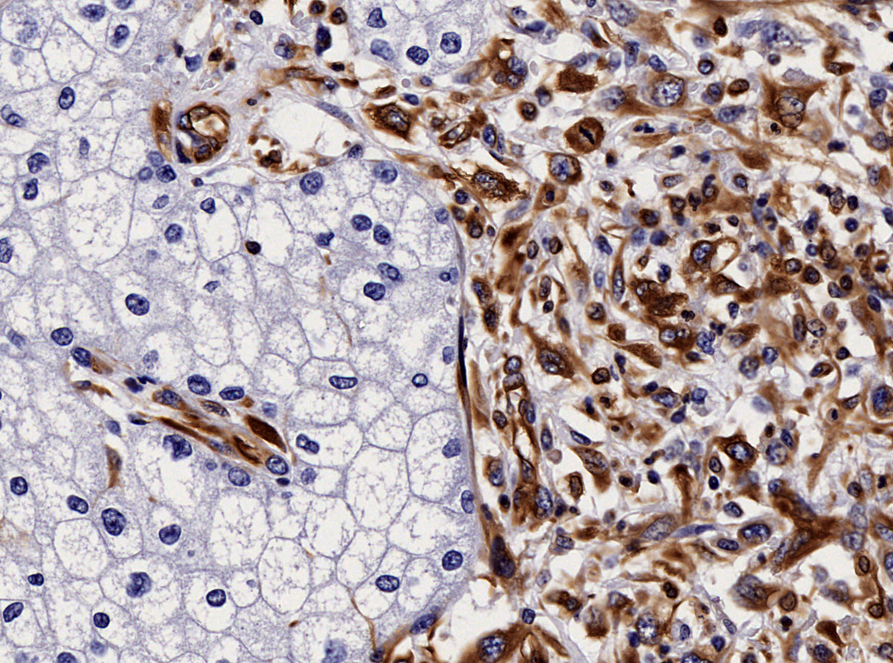 Chromophobe renal cell carcinoma with sarcomatoid differentiation