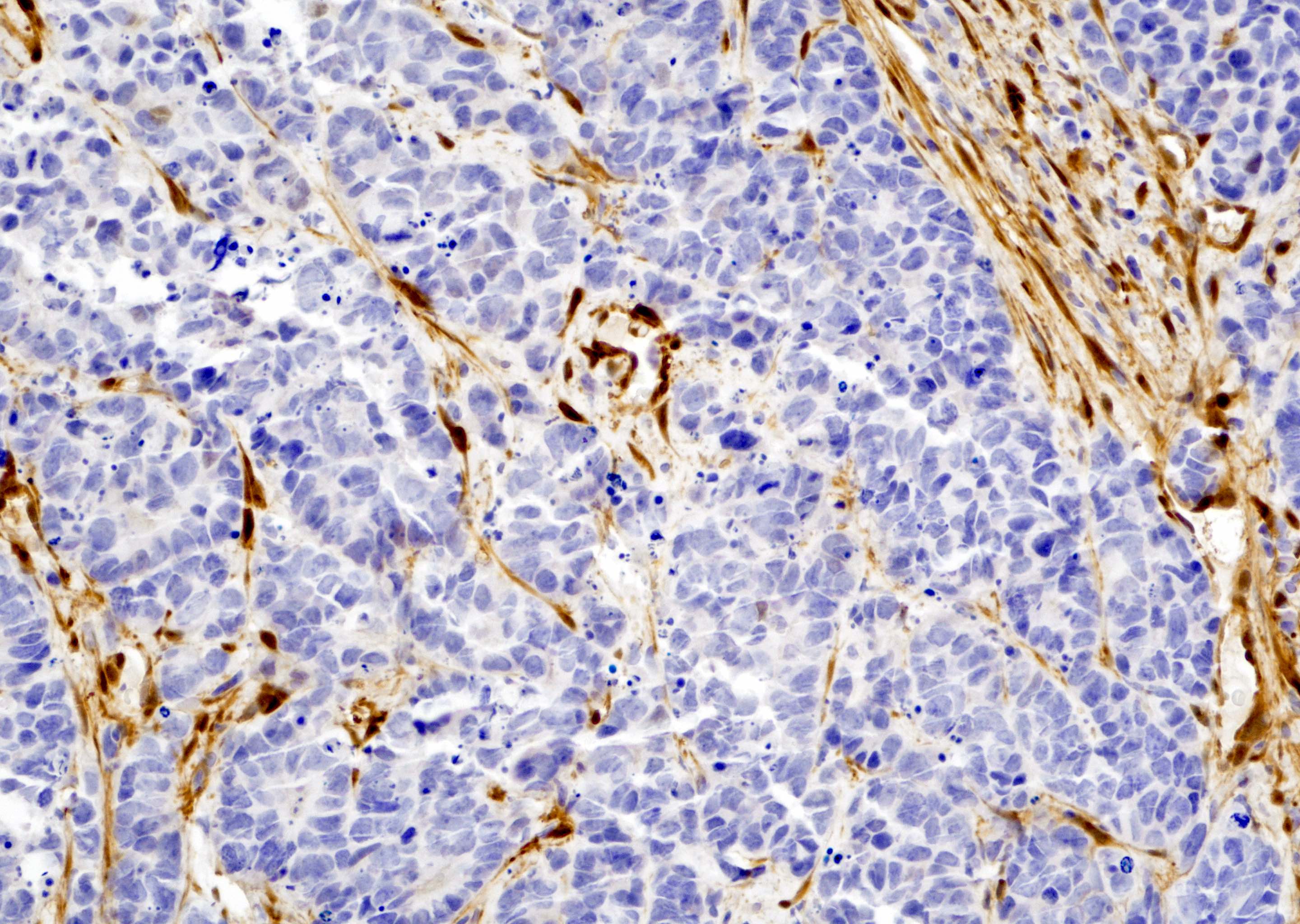 YAP1 in neuroendocrine carcinoma