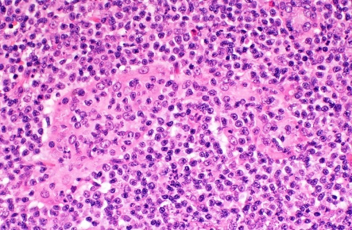 Lymphoepithelial lesion