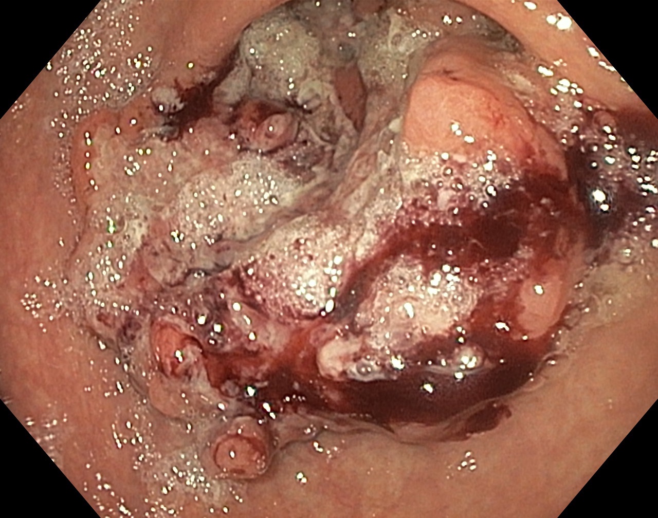 Hemorrhagic gastric mass