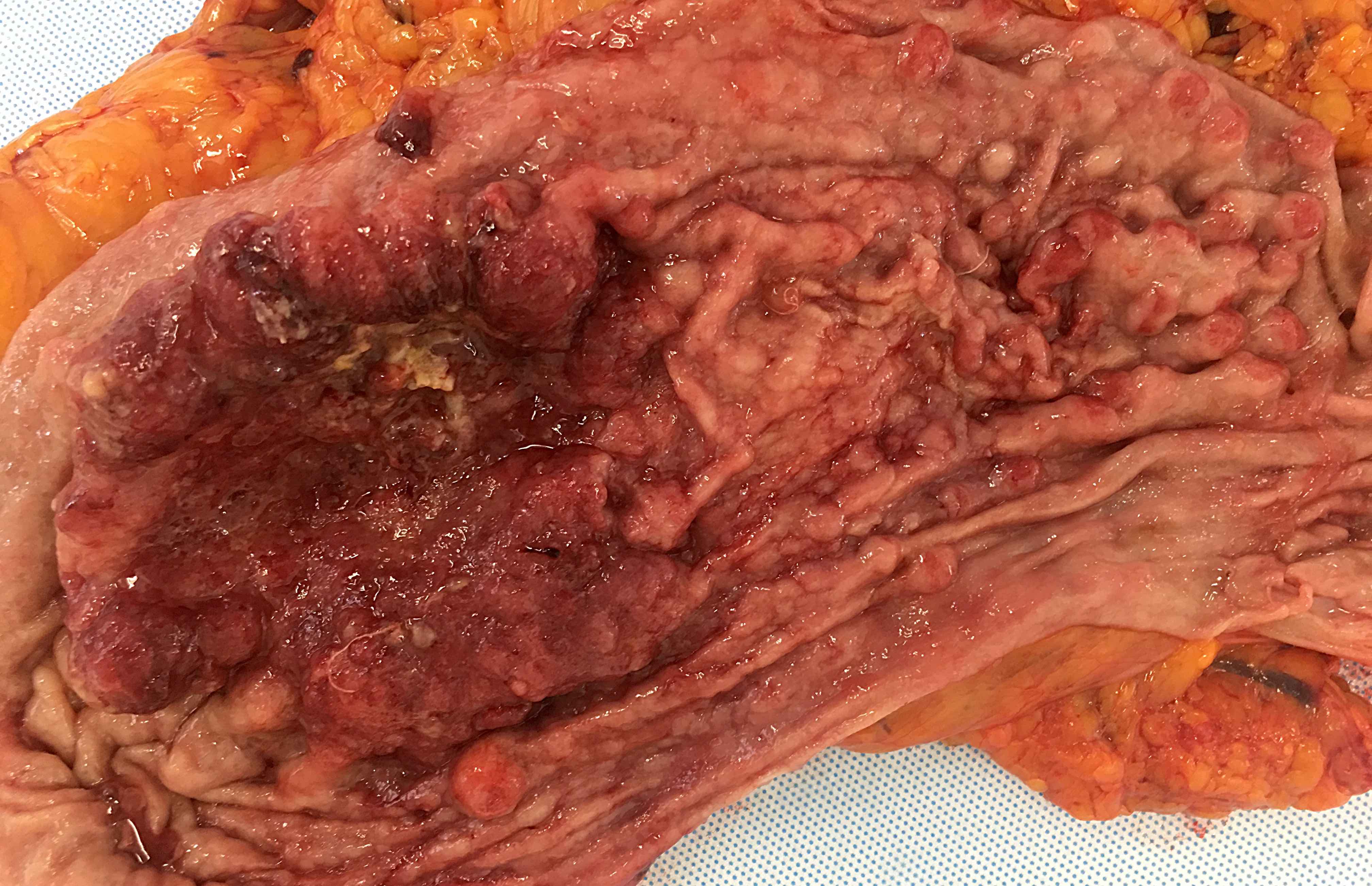 Giant distal gastric mass