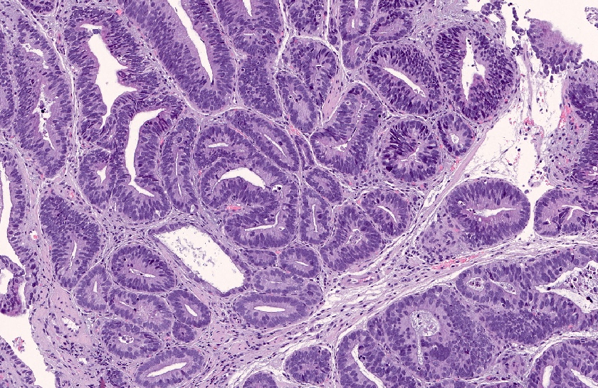 Gastric adenocarcinoma intestinal subtype