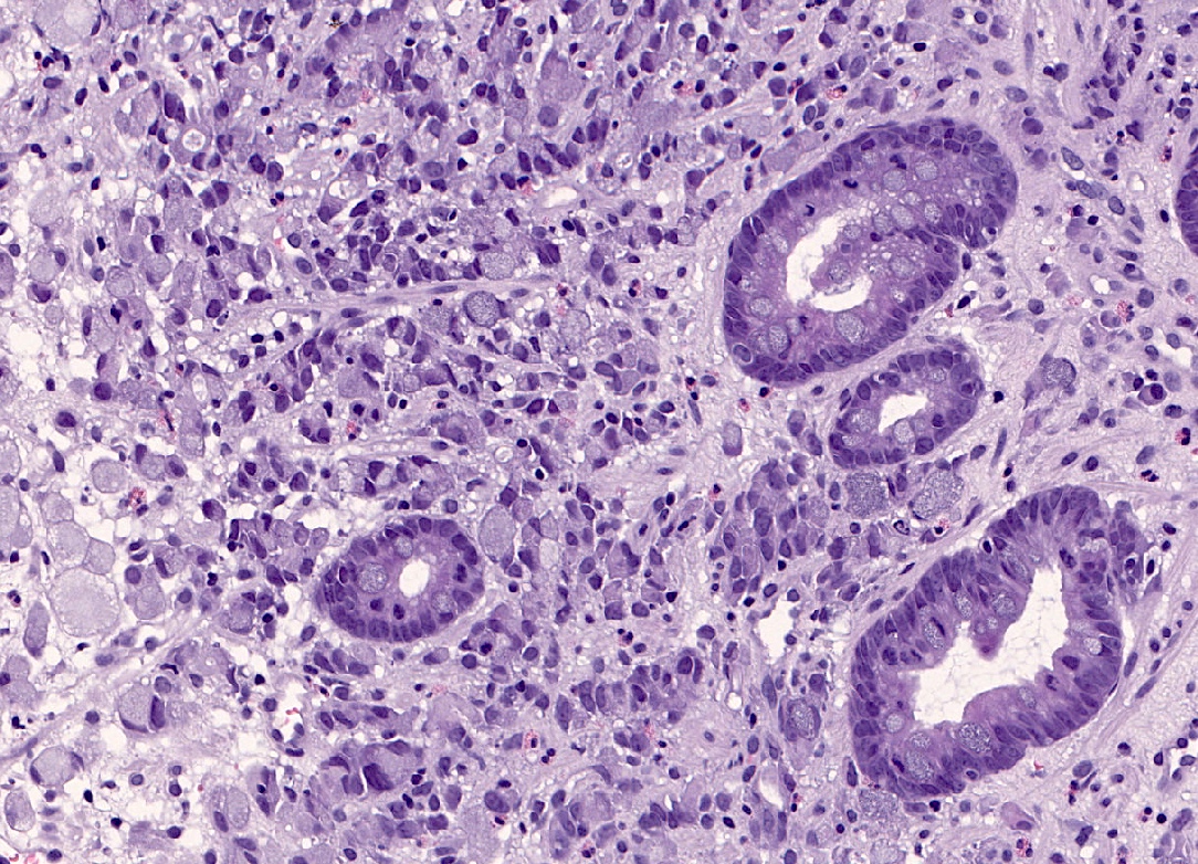 Poorly cohesive adenocarcinoma with signet ring cell phenotype