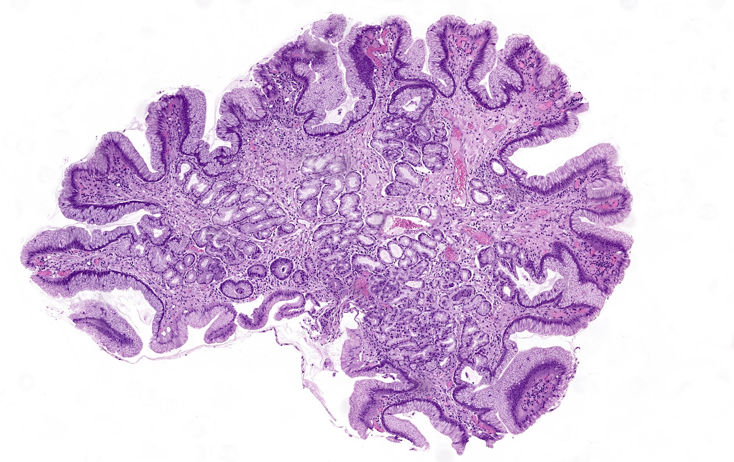 Atrophic Gastritis Pathology atrophic-gastritis-pathology