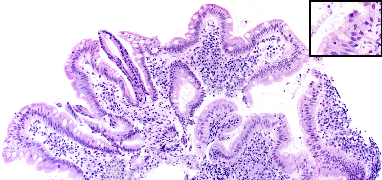 Histology of <i>H. pylori</i> in duodenum