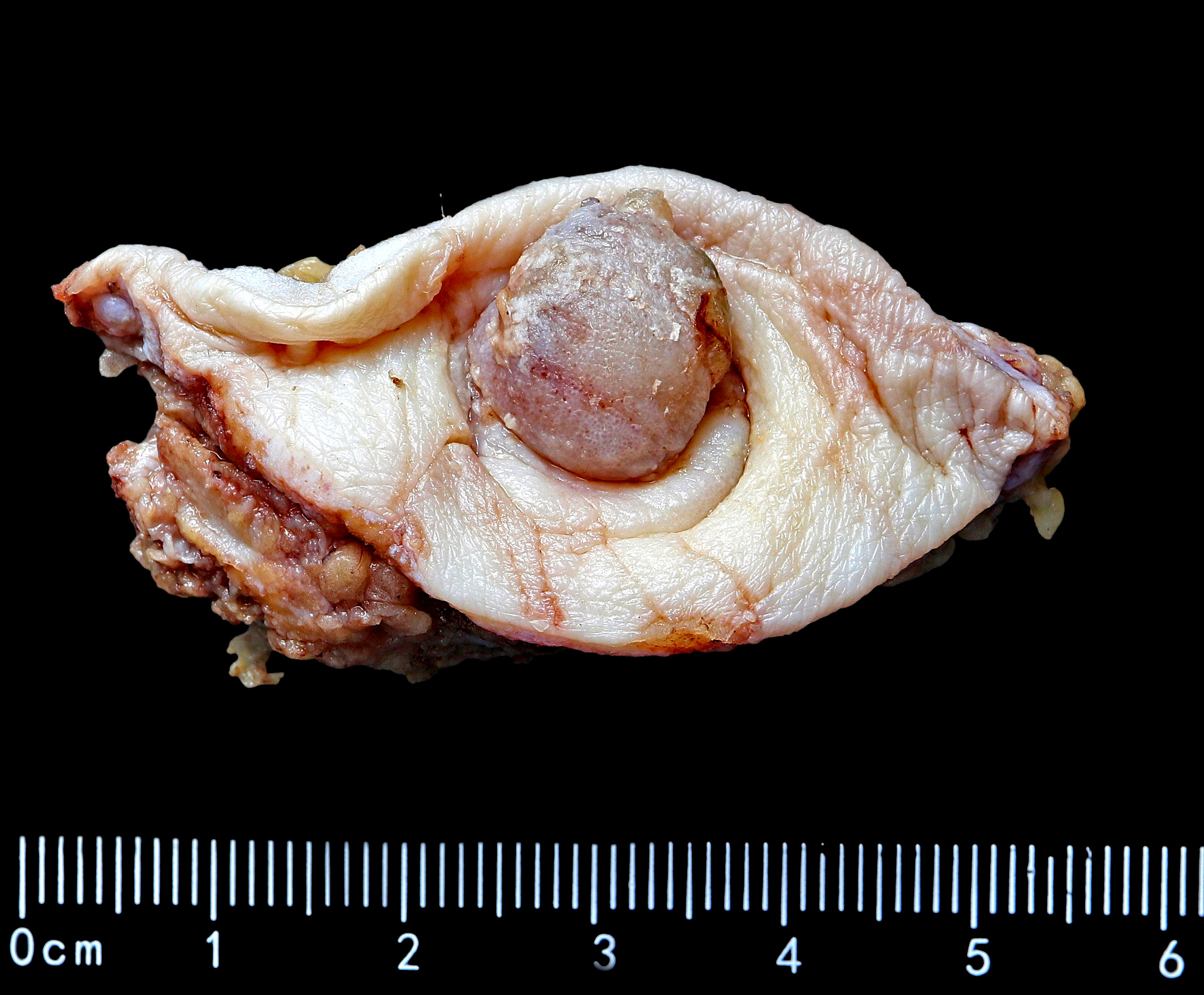 Intestinal type adenocarcinoma