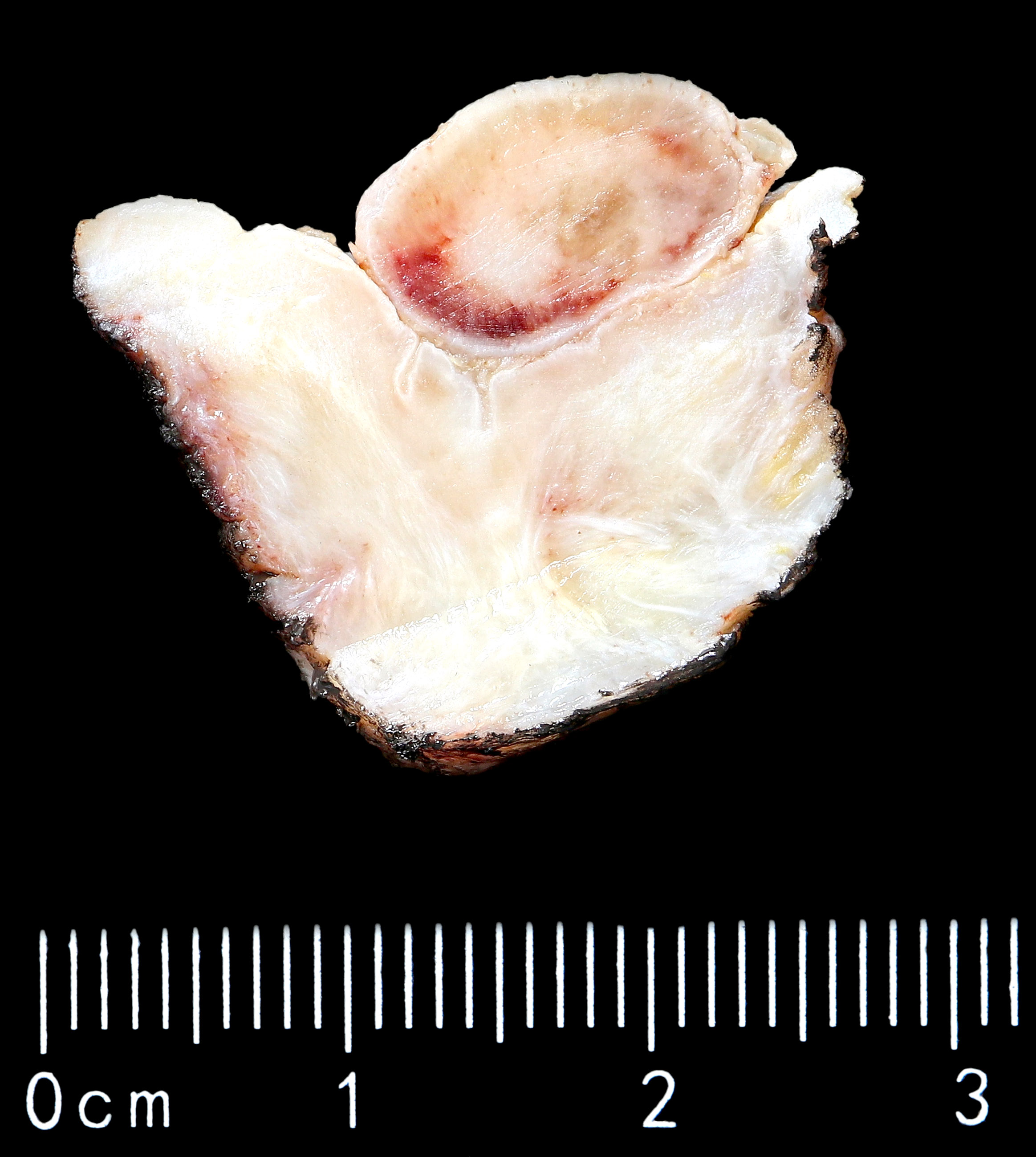 Intestinal type adenocarcinoma