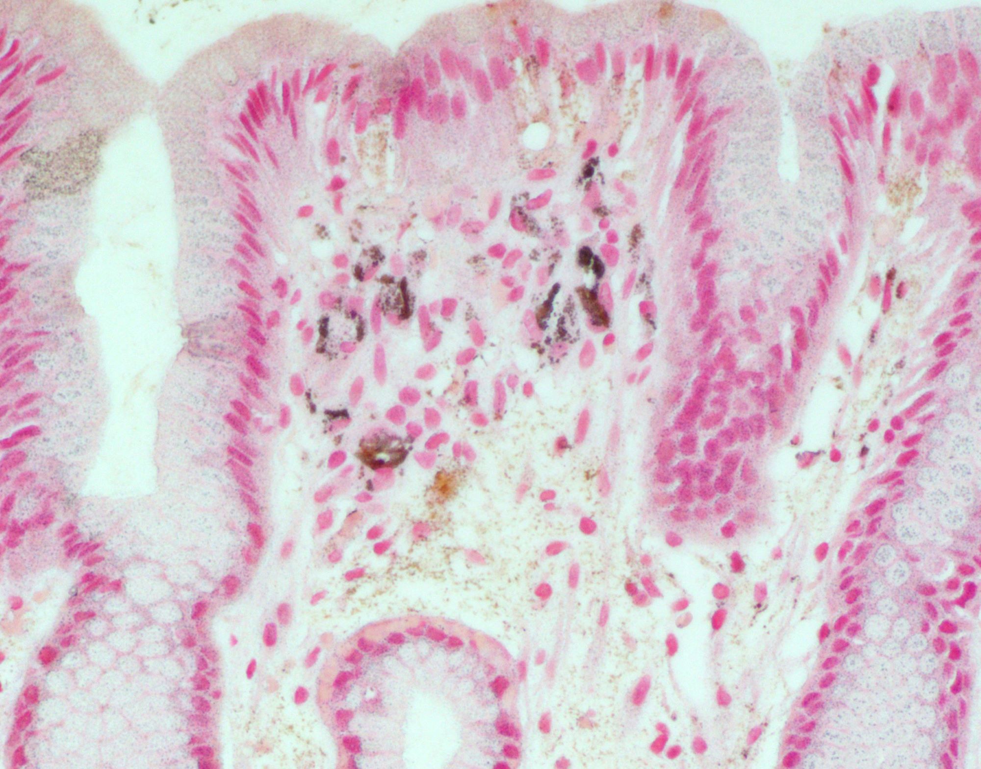 Mucosal calcinosis von Kossa stain
