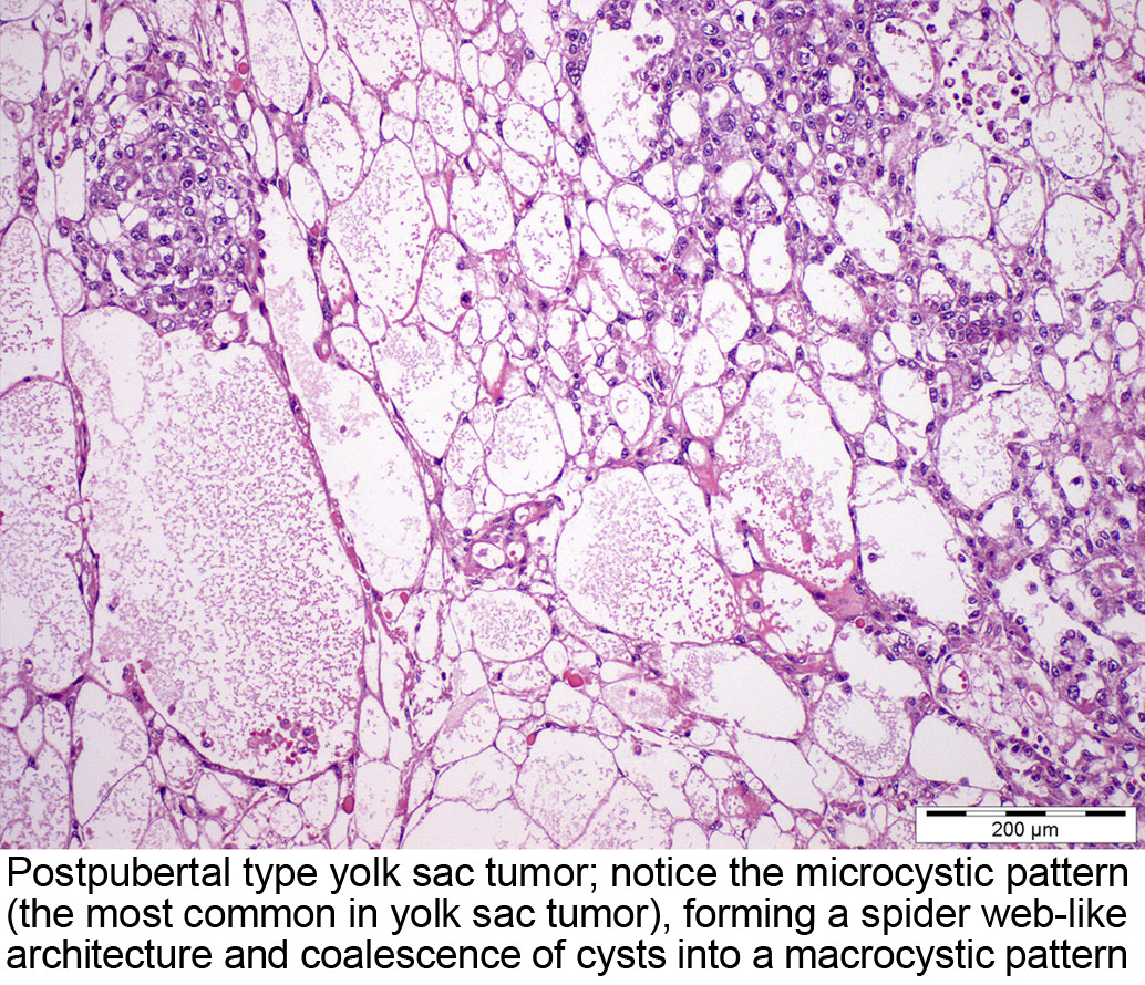 Pathology Outlines Yolk Sac Tumor