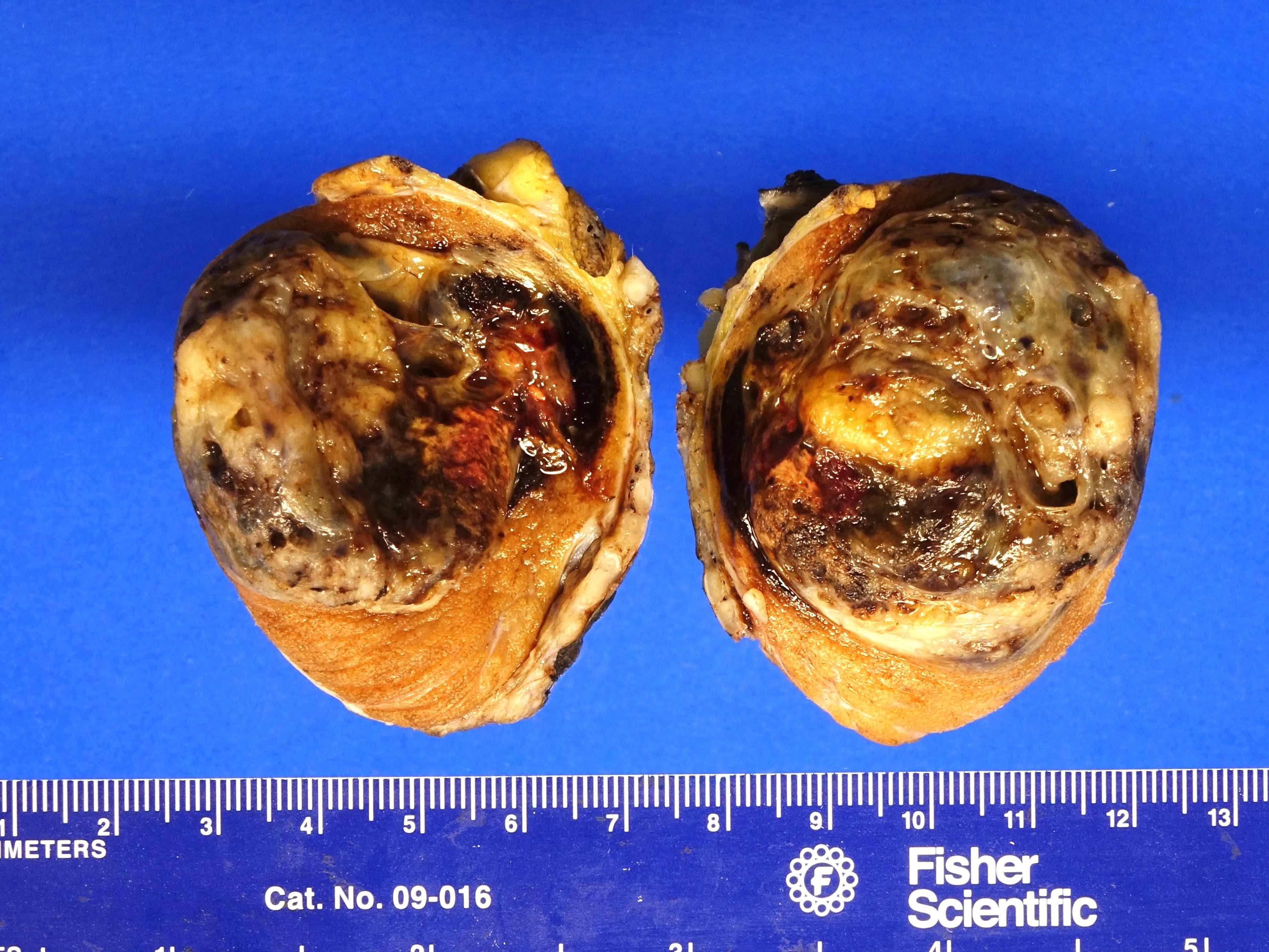 Mixed GCT with minor component of choriocarcinoma