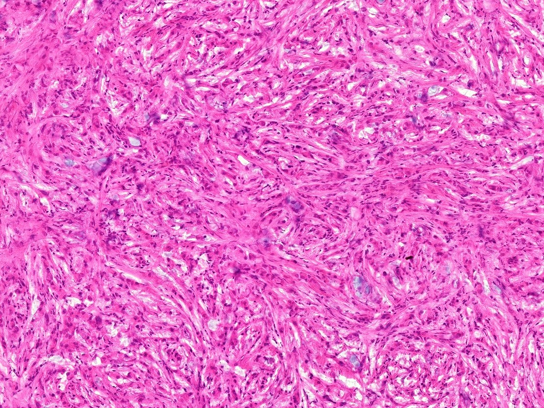 Spindle cell appearance