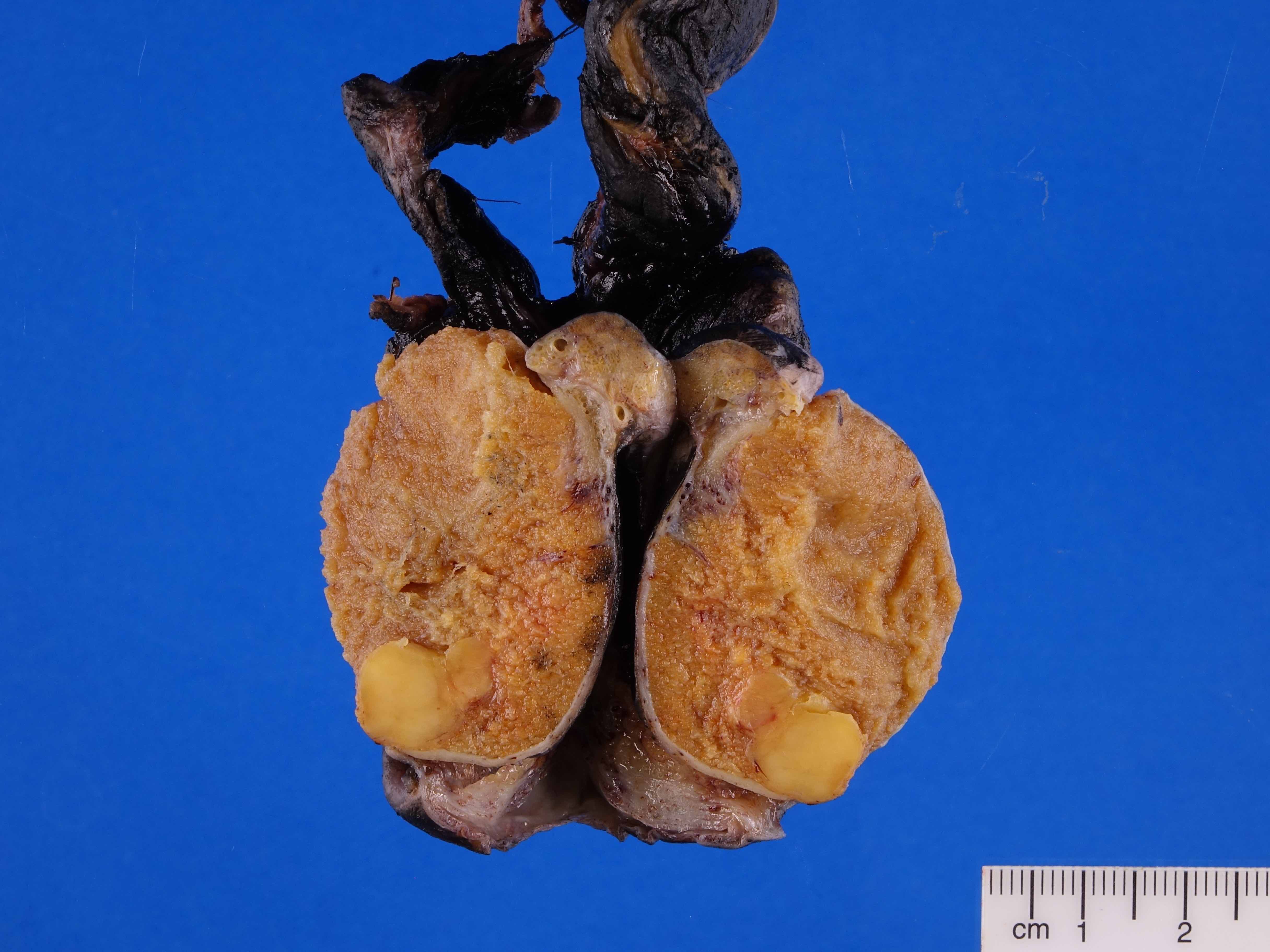Nodular tumor