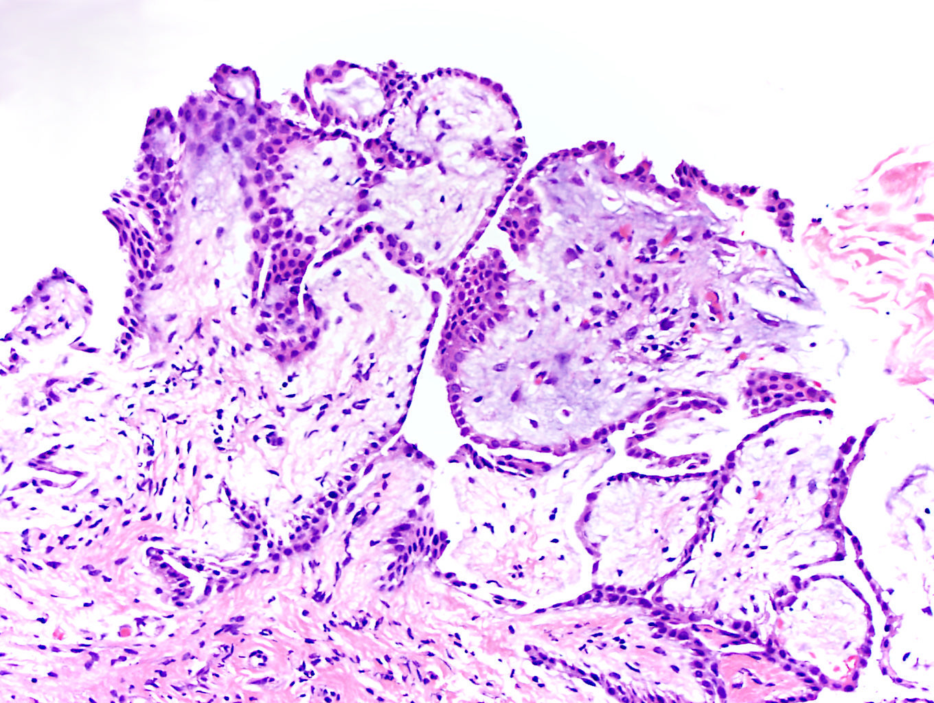 Papillae with myxoid stroma
