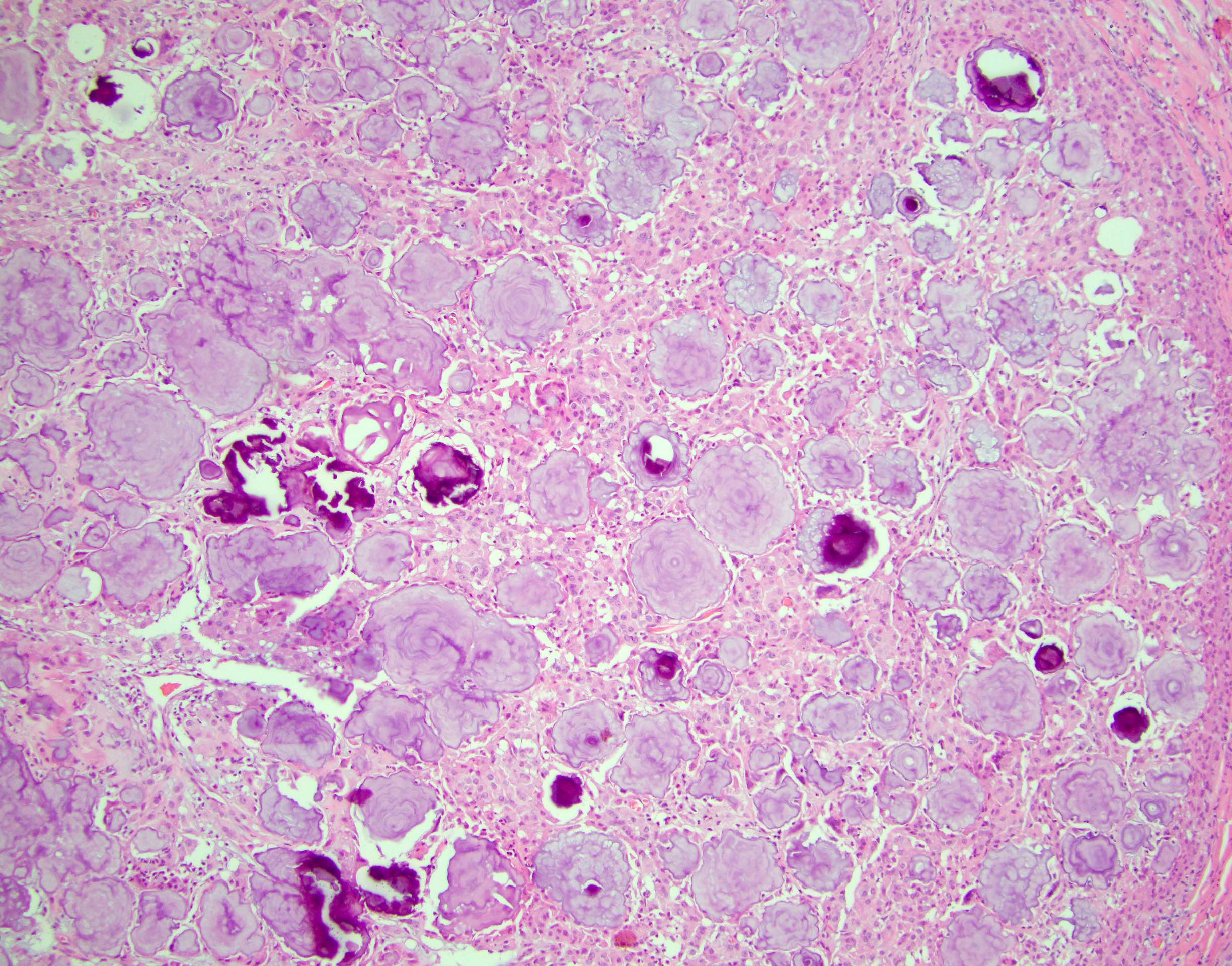 Mulberry calcifications