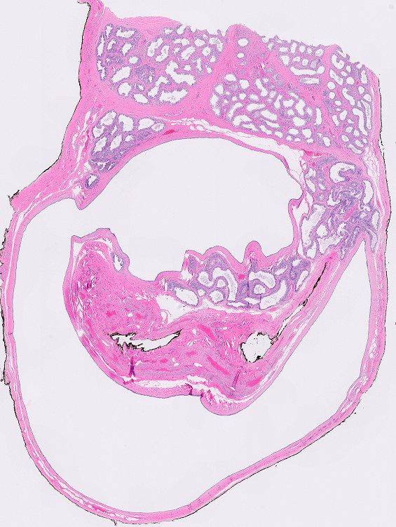 Spermatocele with adjacent epididymis