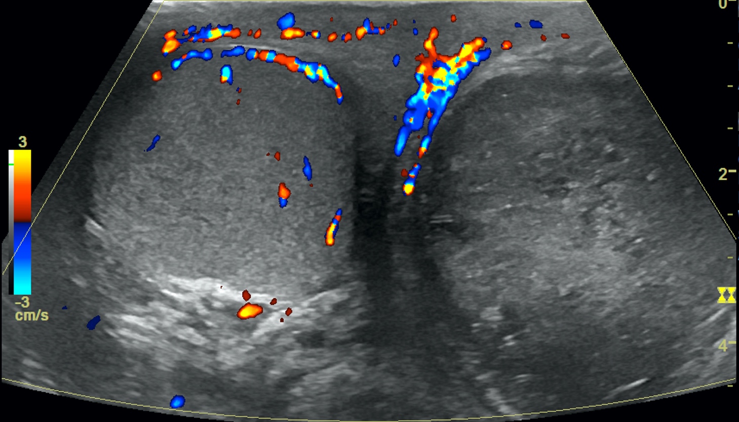 Ultrasound of bilateral testis