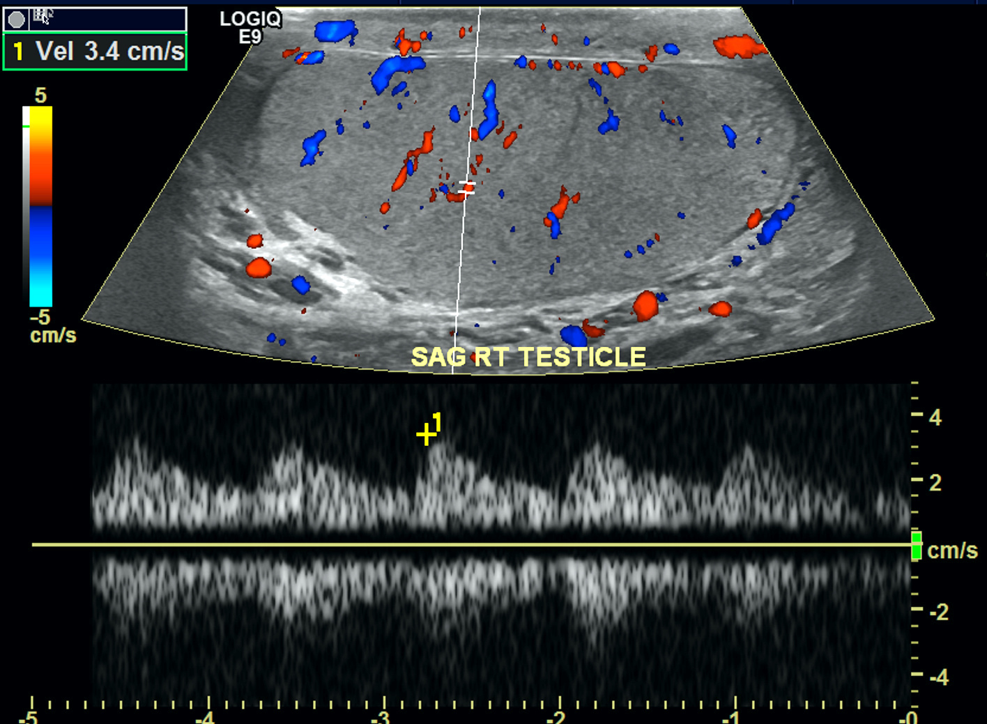 Ultrasound of right normal testis
