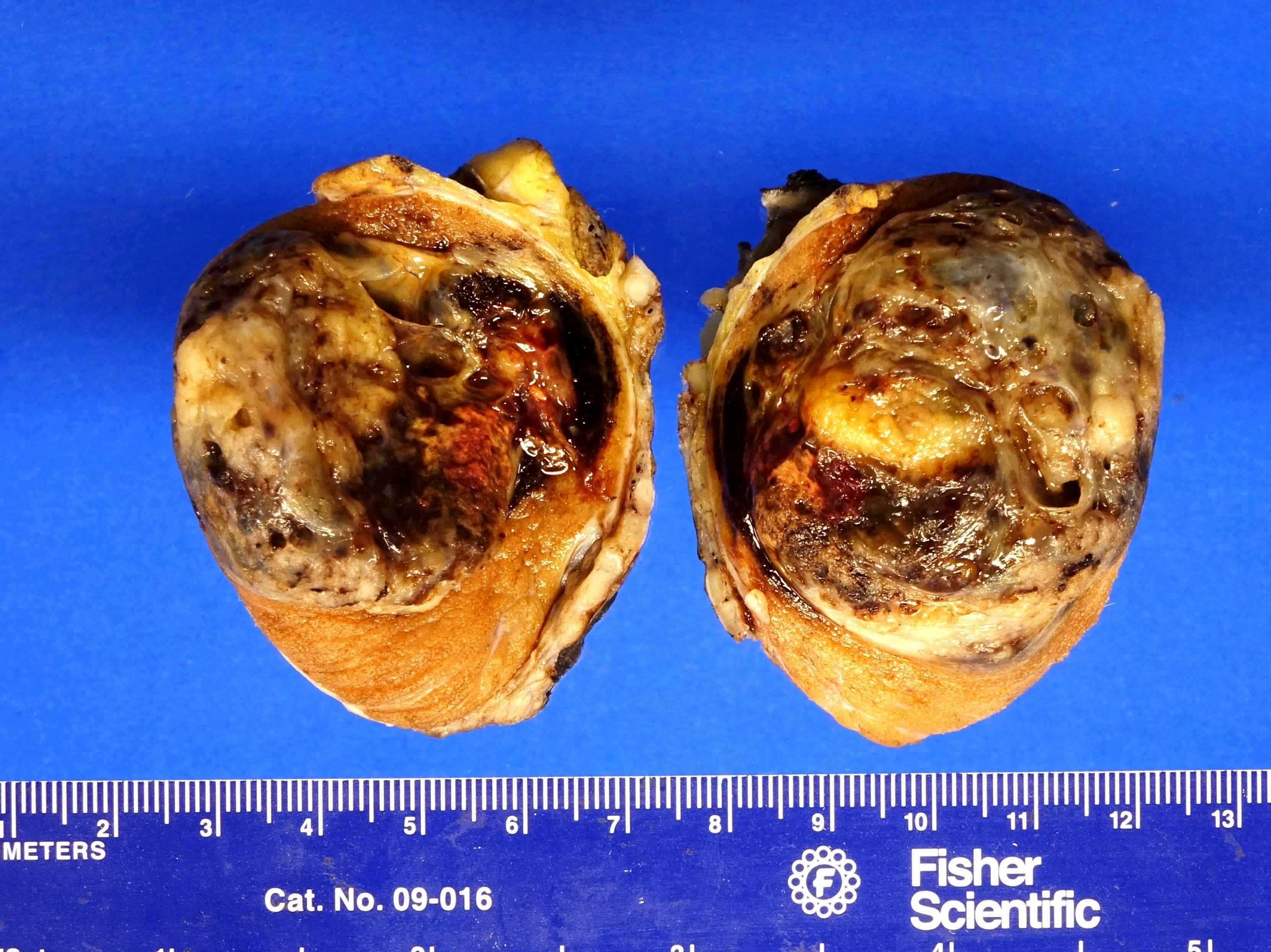 Mixed germ cell tumor, postpubertal with varying % of yolk sac tumor