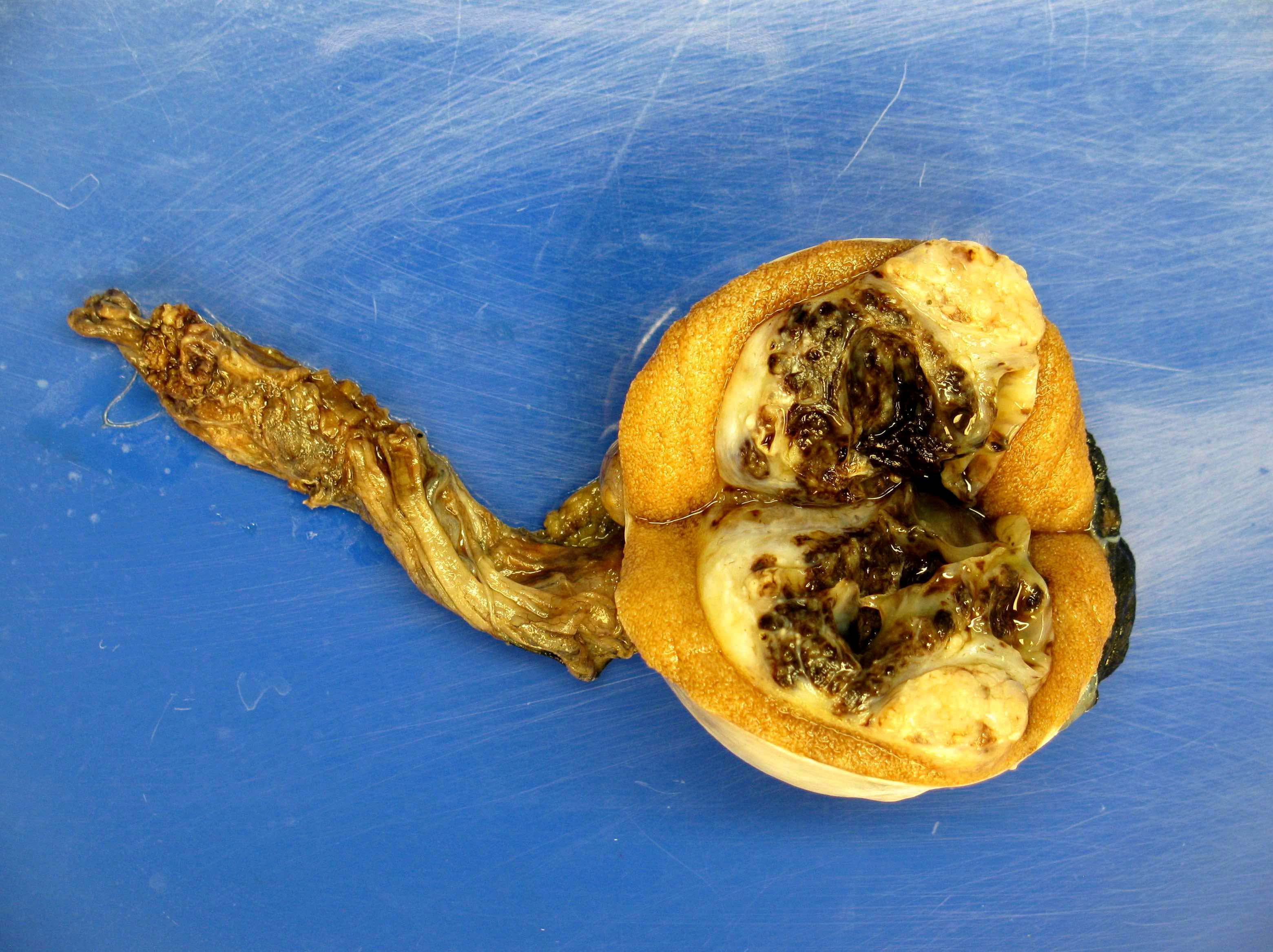 Mixed germ cell tumor, postpubertal with varying % of yolk sac tumor