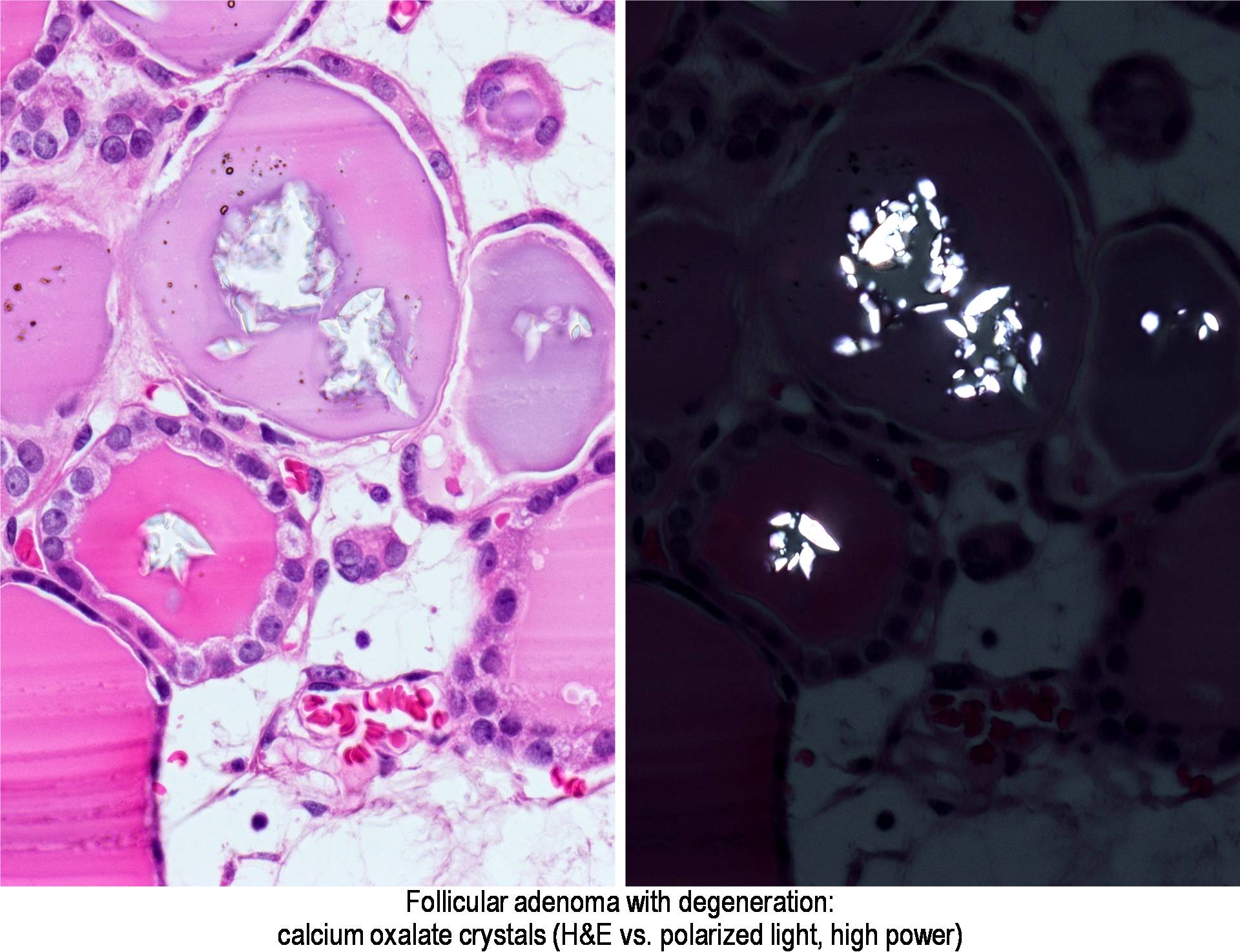 Pathology Outlines Calcification