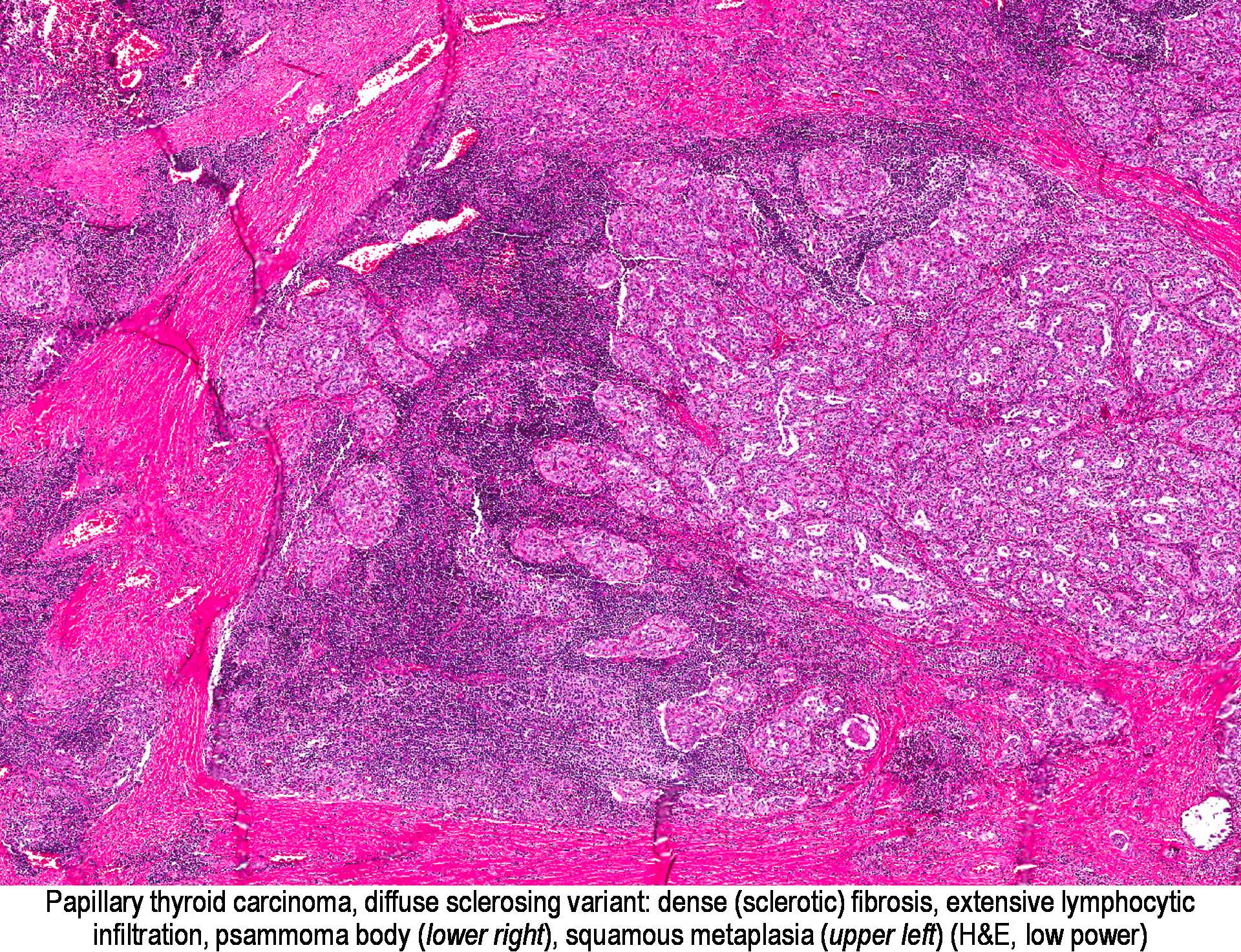Fibrosis and lymphocytic infiltration