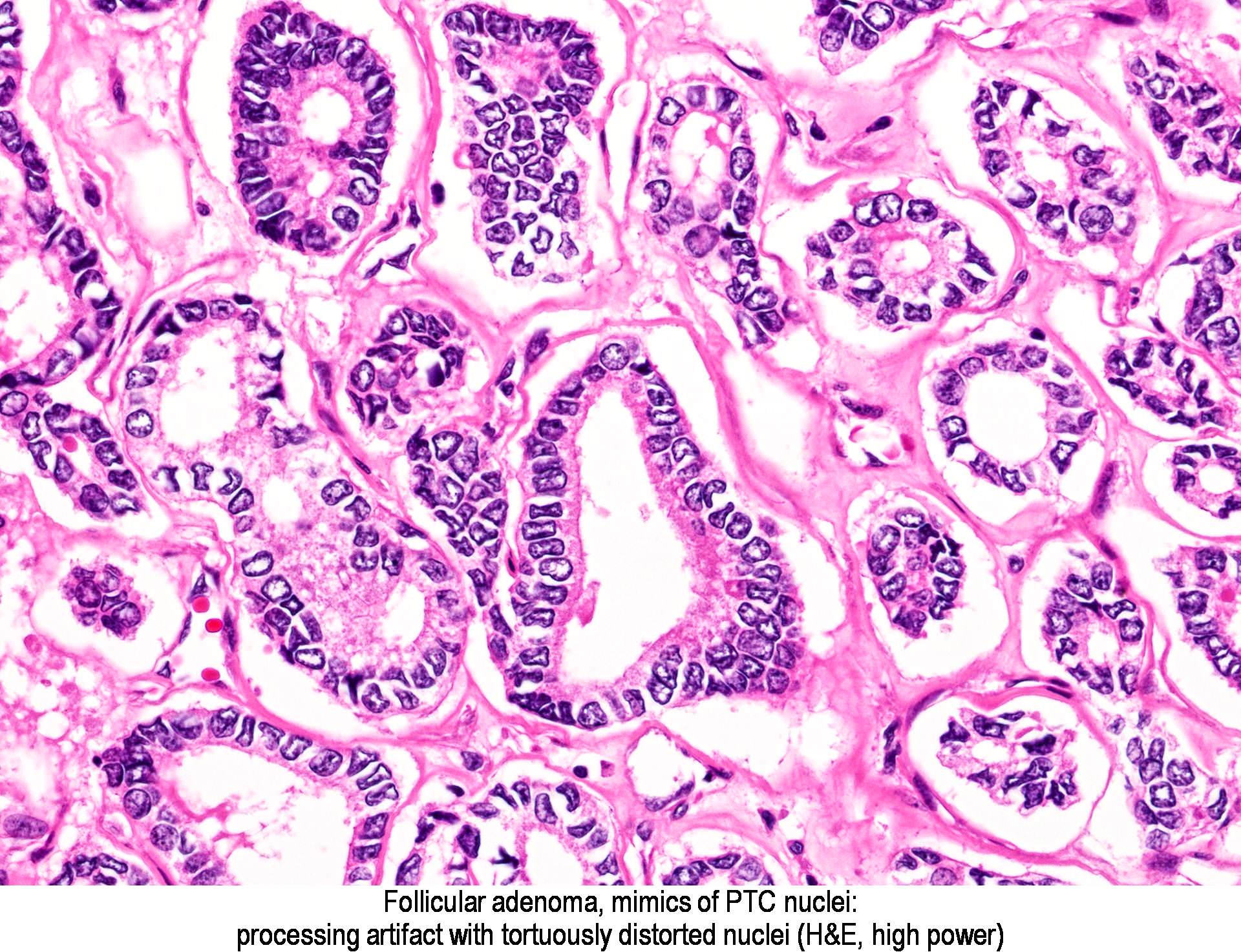 papillary adenoma pathology outlines)