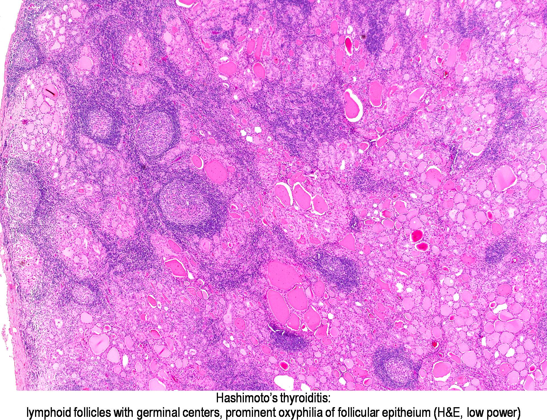Pathology Outlines - Hashimoto thyroiditis