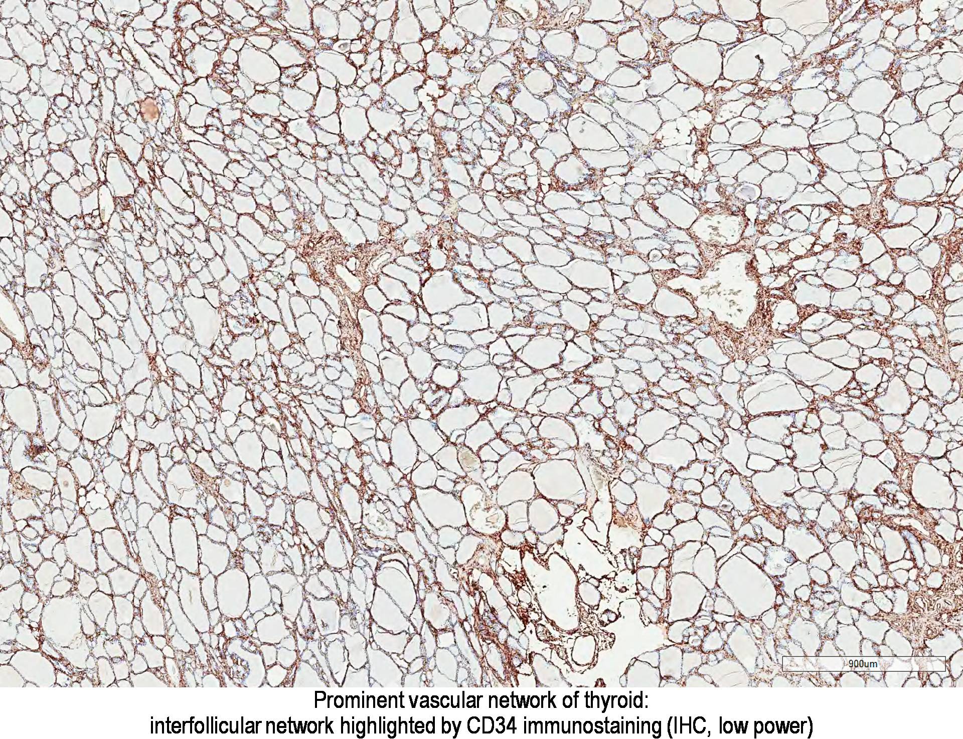 squamous cell carcinoma skin of back icd 10