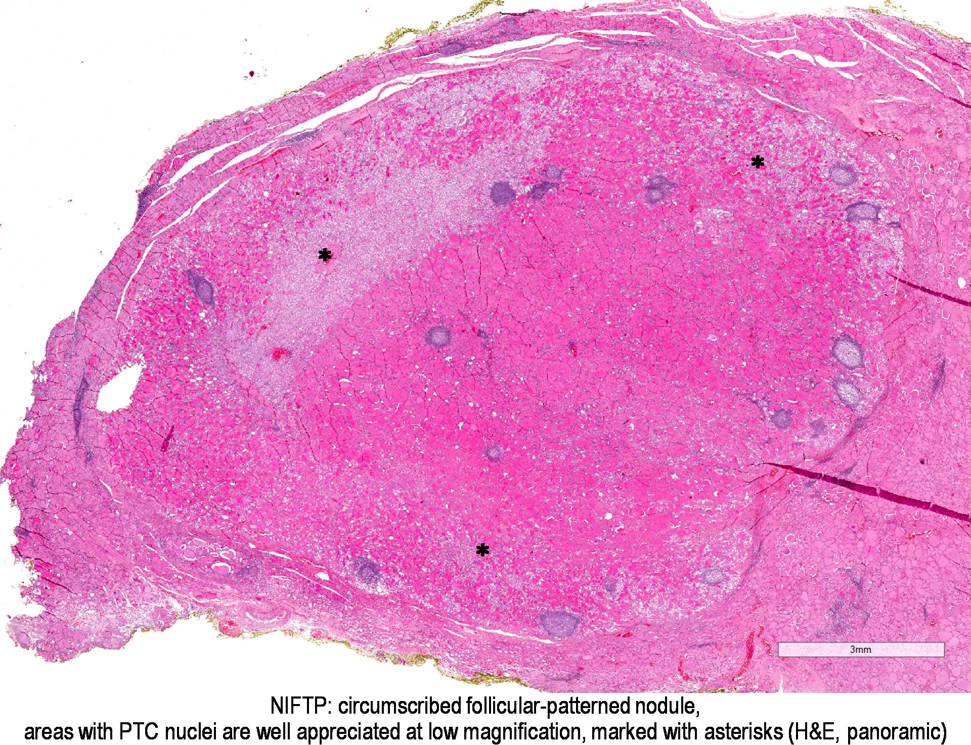 Pathology Outlines - Noninvasive follicular thyroid neoplasm with ...