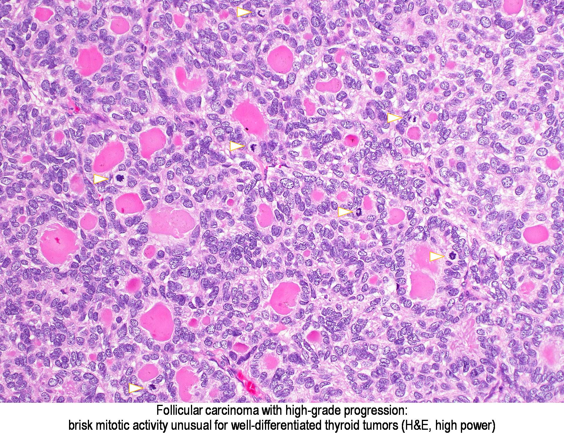 Pathology Outlines - Follicular carcinoma