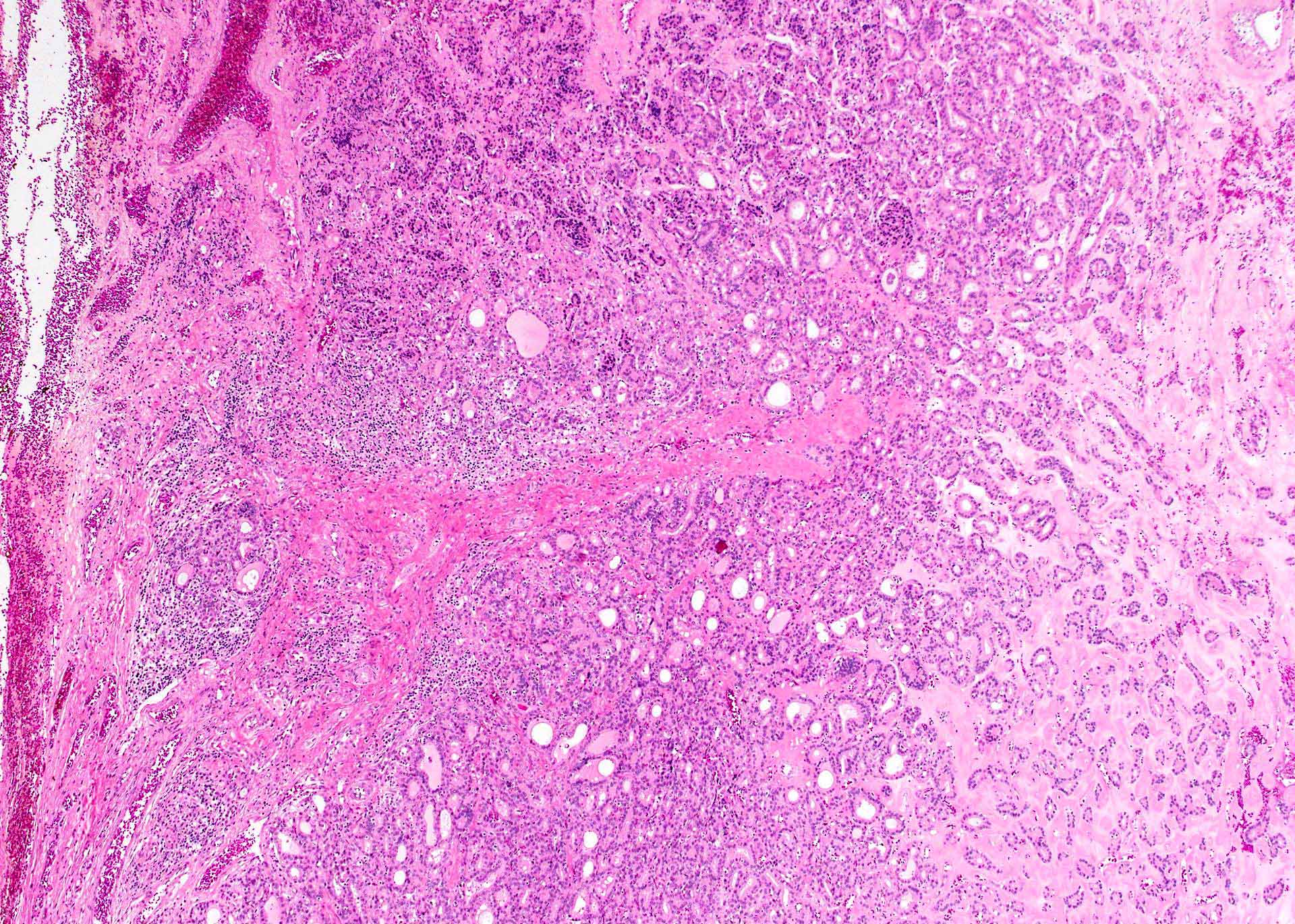 FNA induced alterations in thyroid nodule