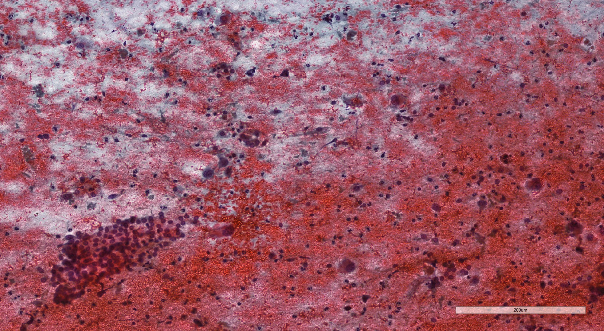 Differentiated thyroid carcinoma component