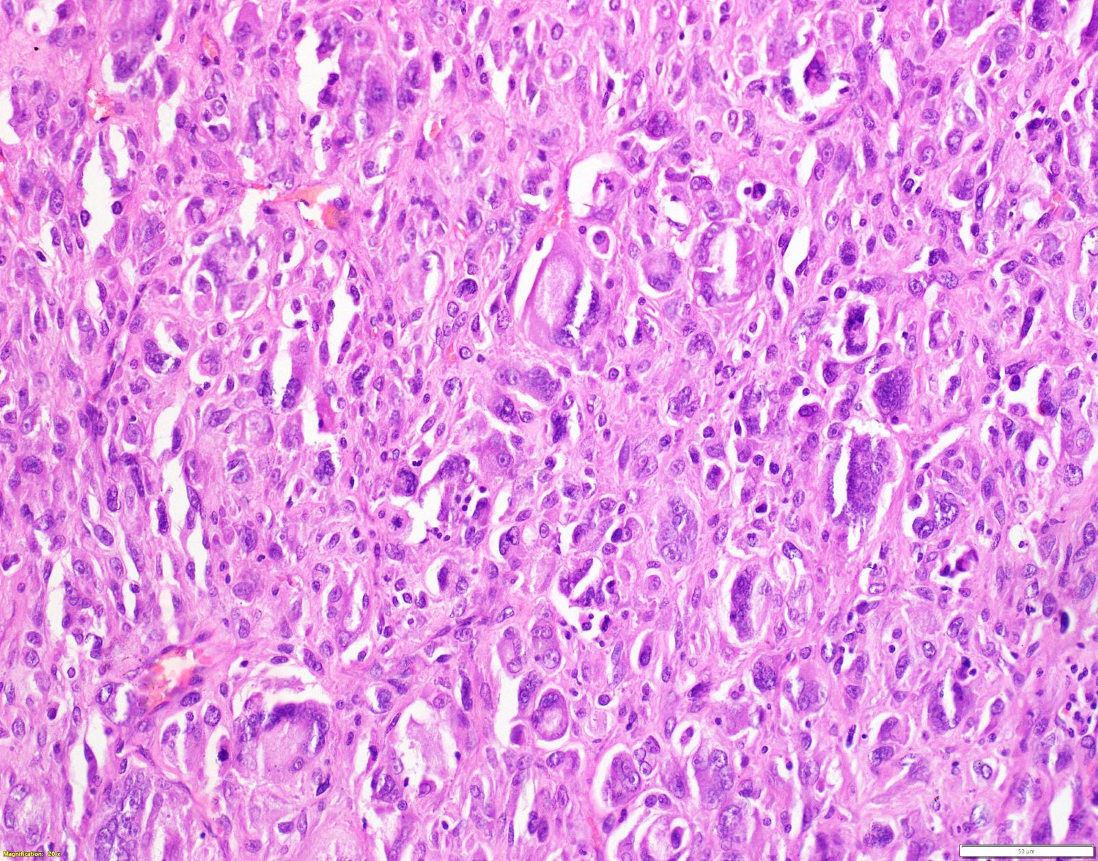 Tumor giant cells