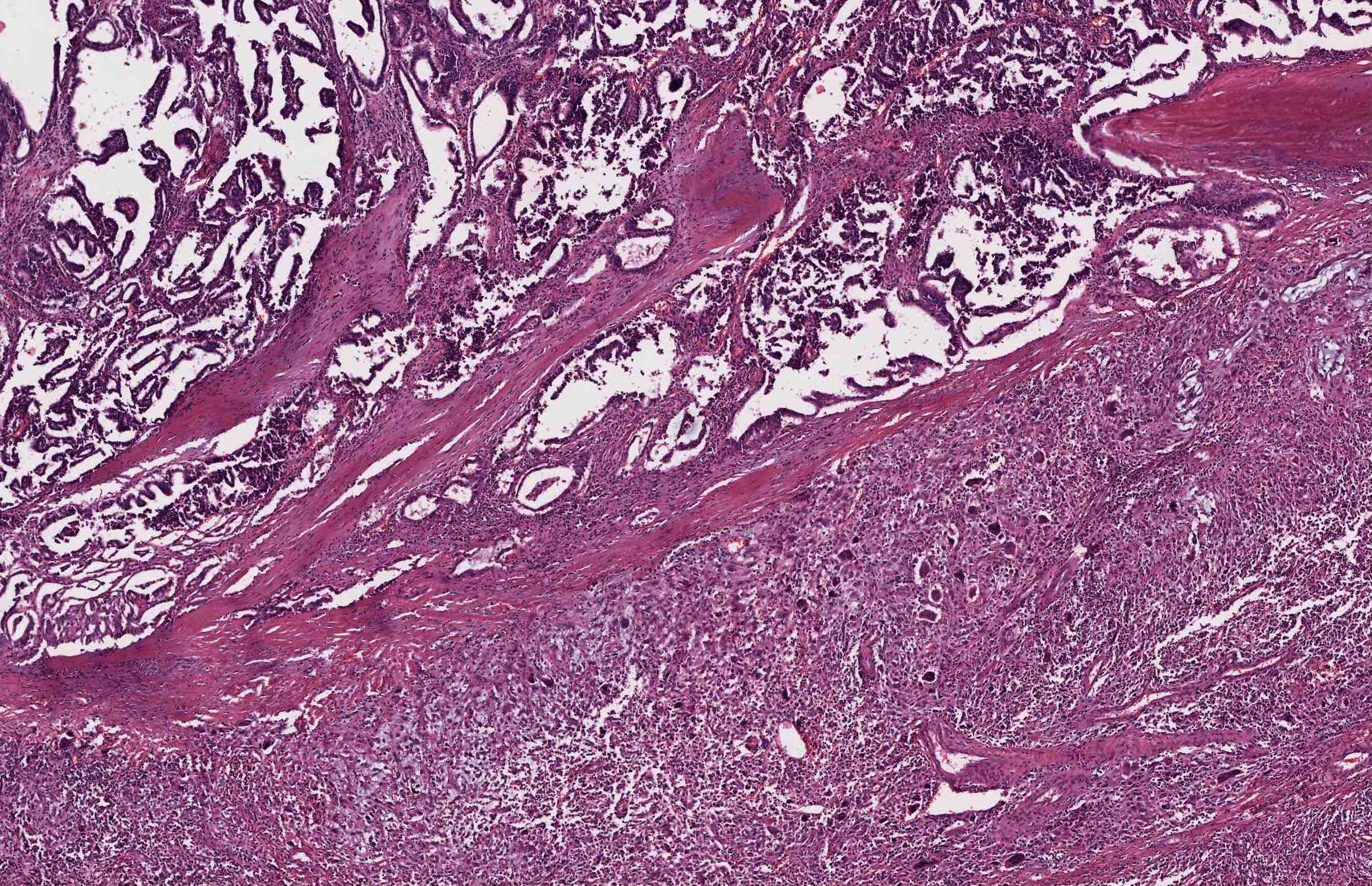 Anaplastic carcinoma and adjacent papillary thyroid carcinoma