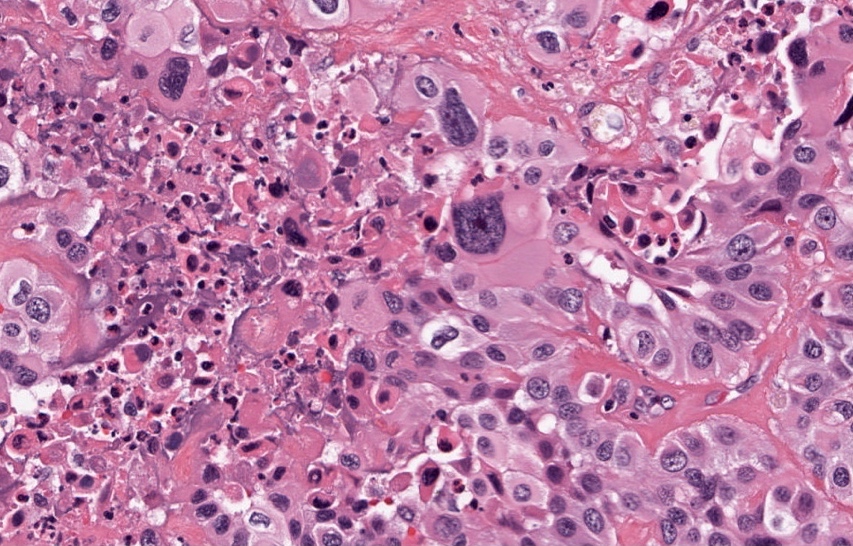 Anaplastic carcinoma with necrosis and inflammation