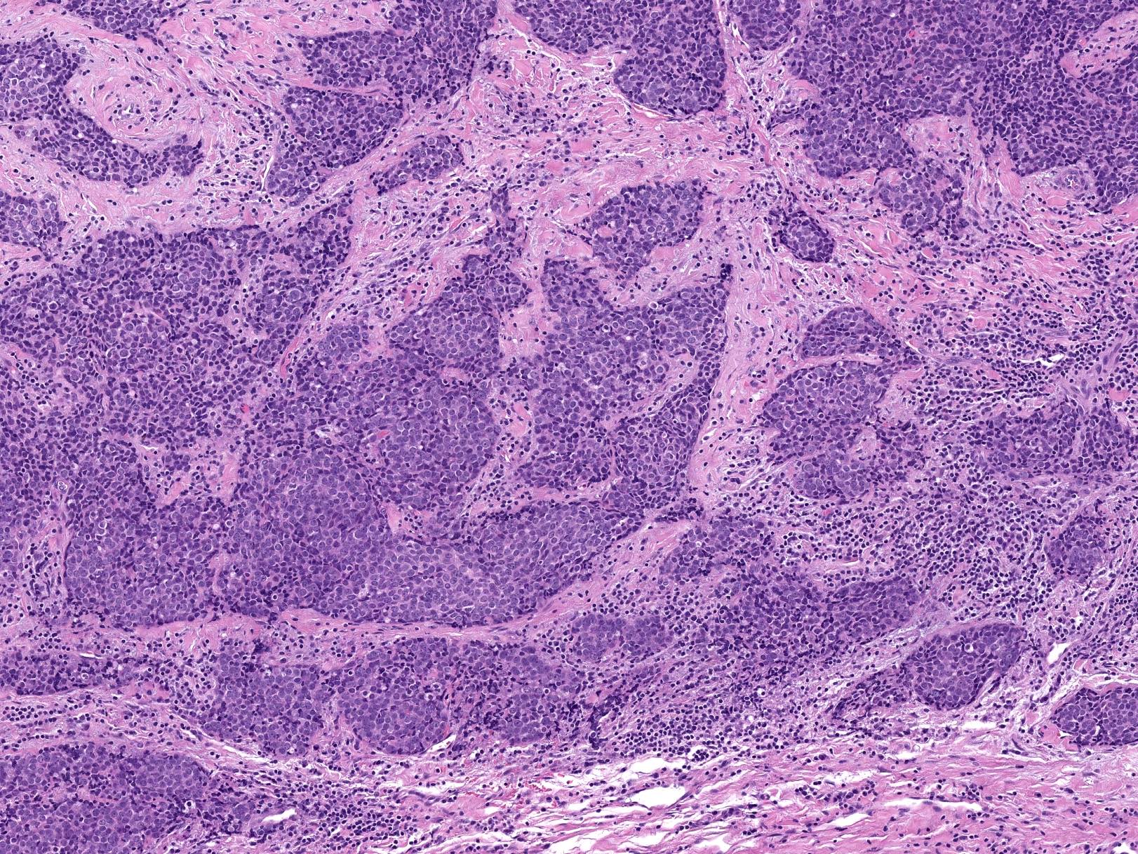 Tumor nests and fibrosis