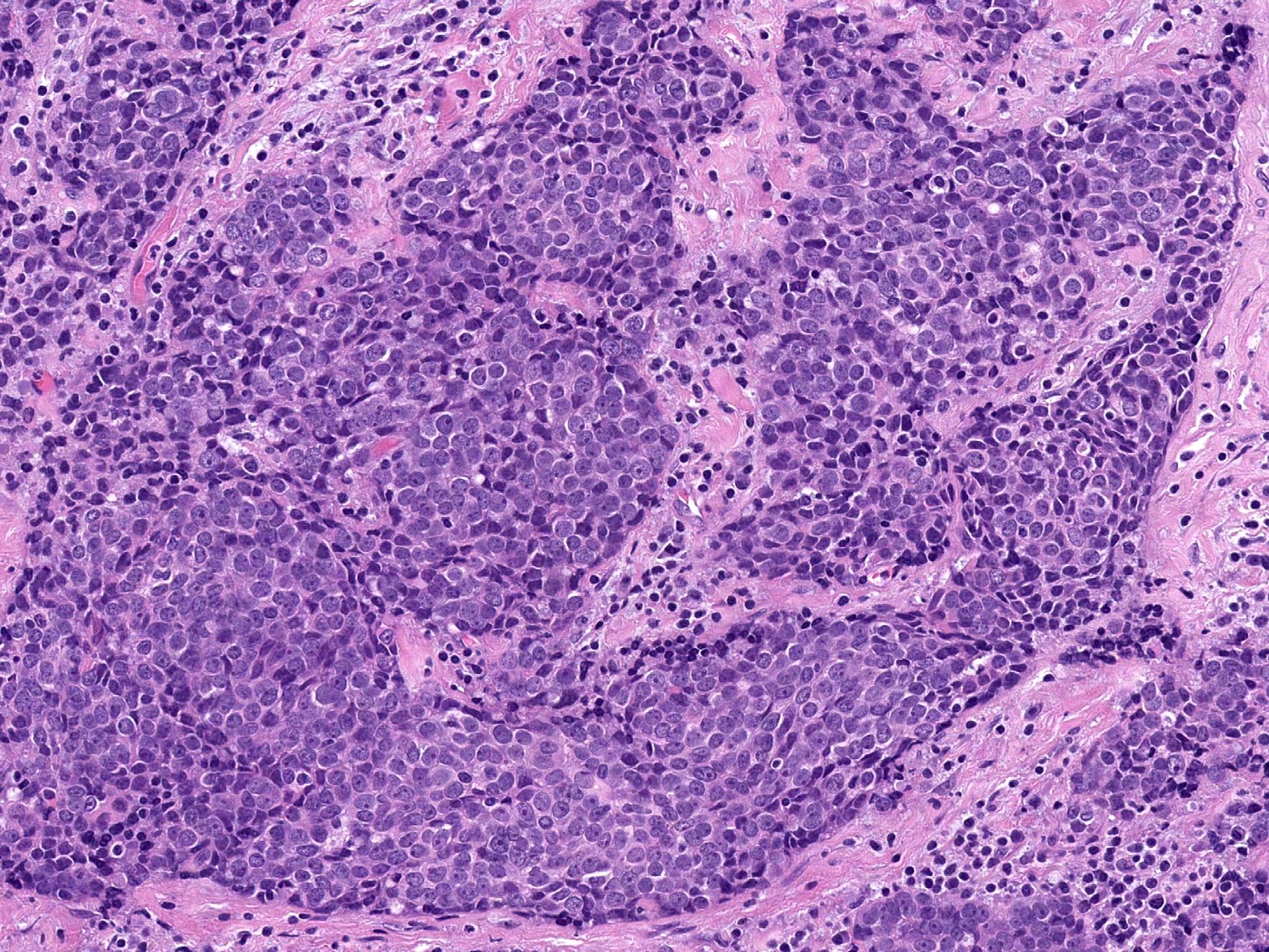 Tumor nests and fibrosis