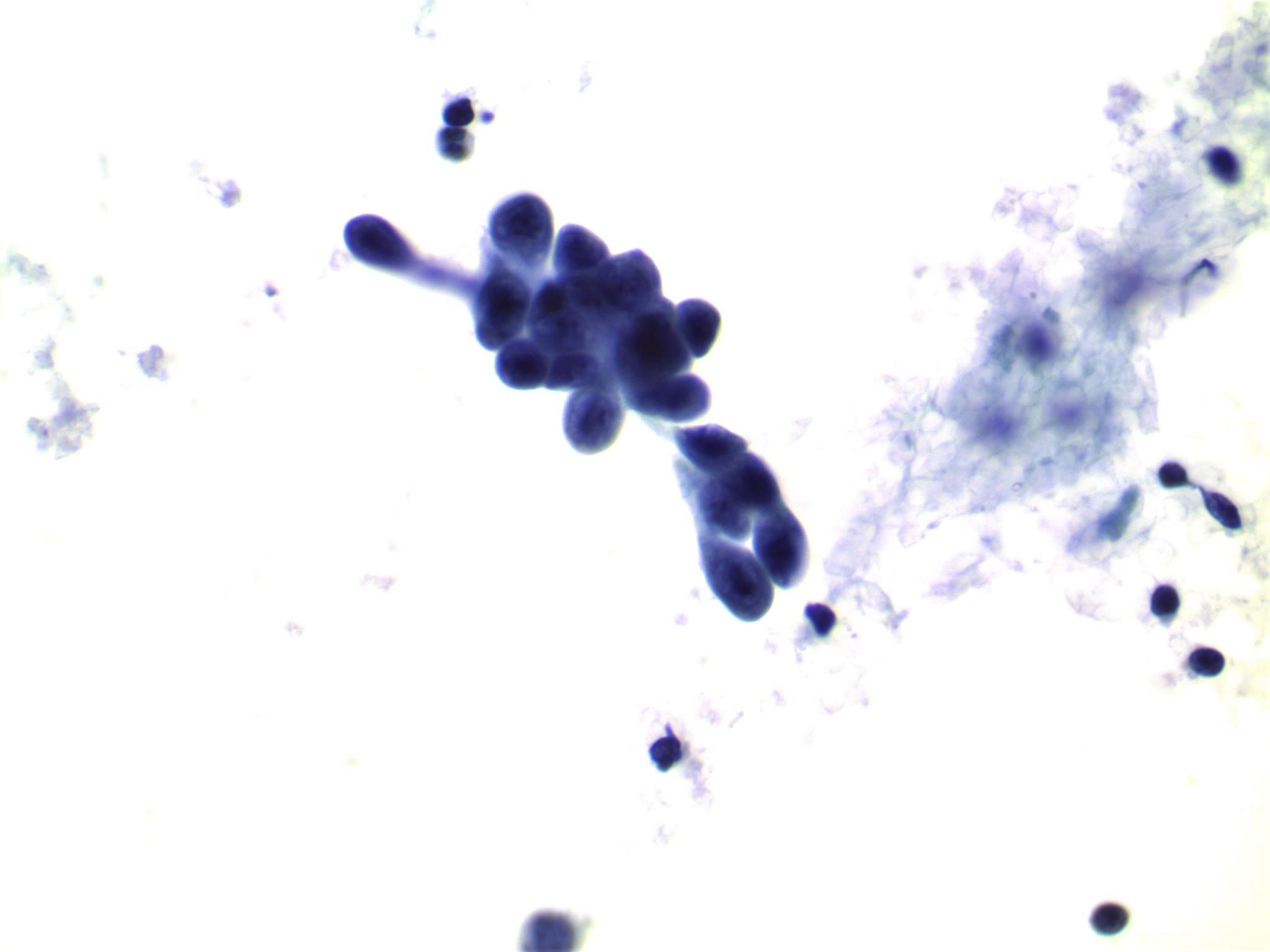 Cytological and architectural atypia