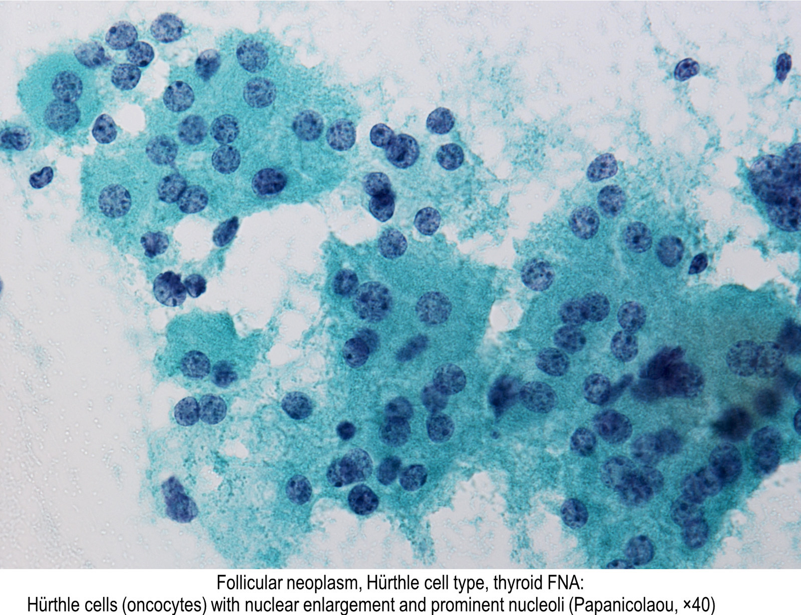 Pathology Outlines - Hürthle cell neoplasm