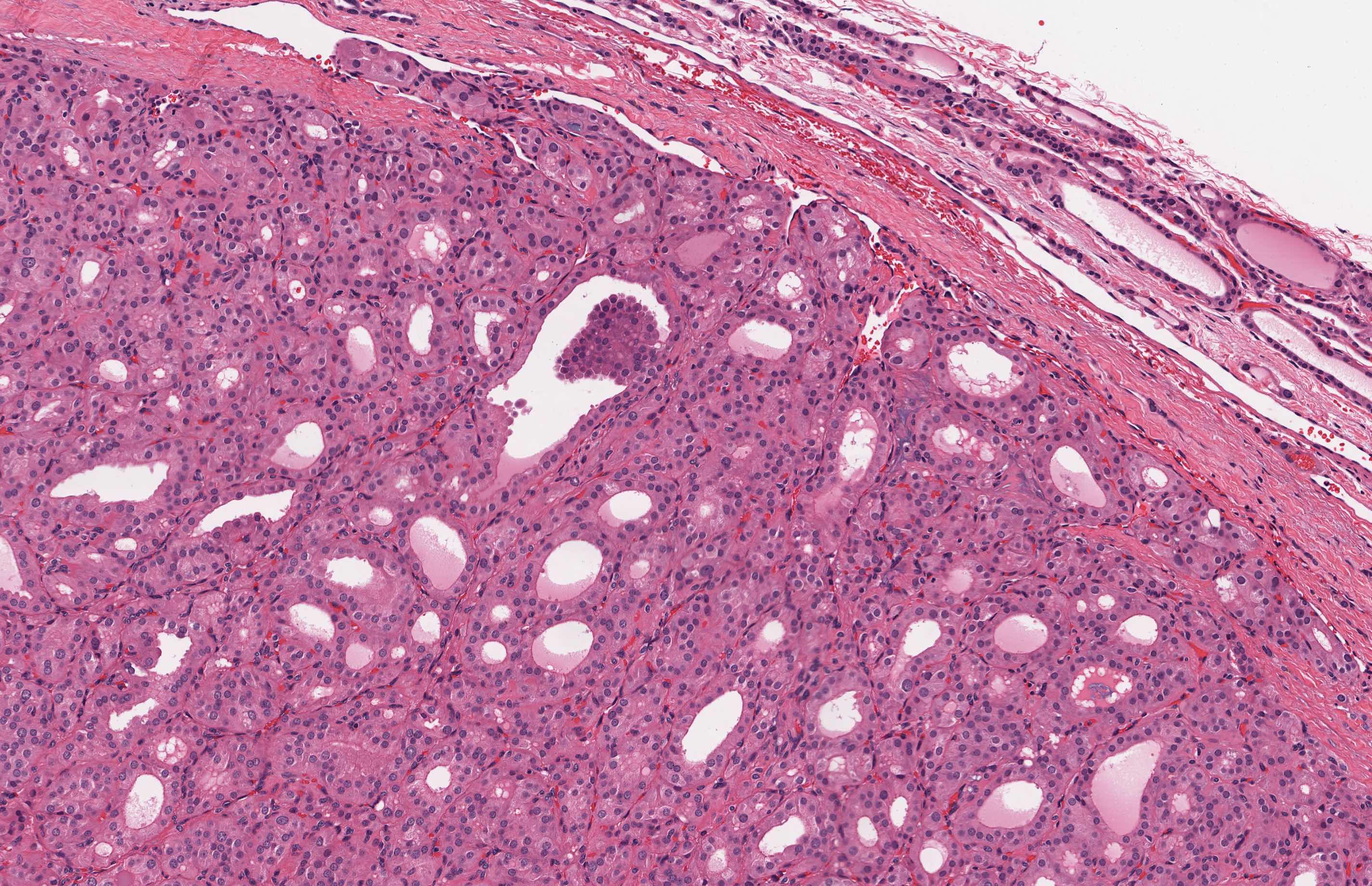 Pathology Outlines - Oncocytic (Hürthle cell) tumors
