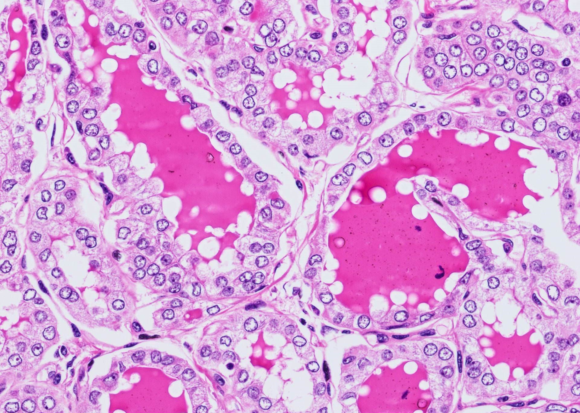 Vesicular nuclei with irregular membranes
