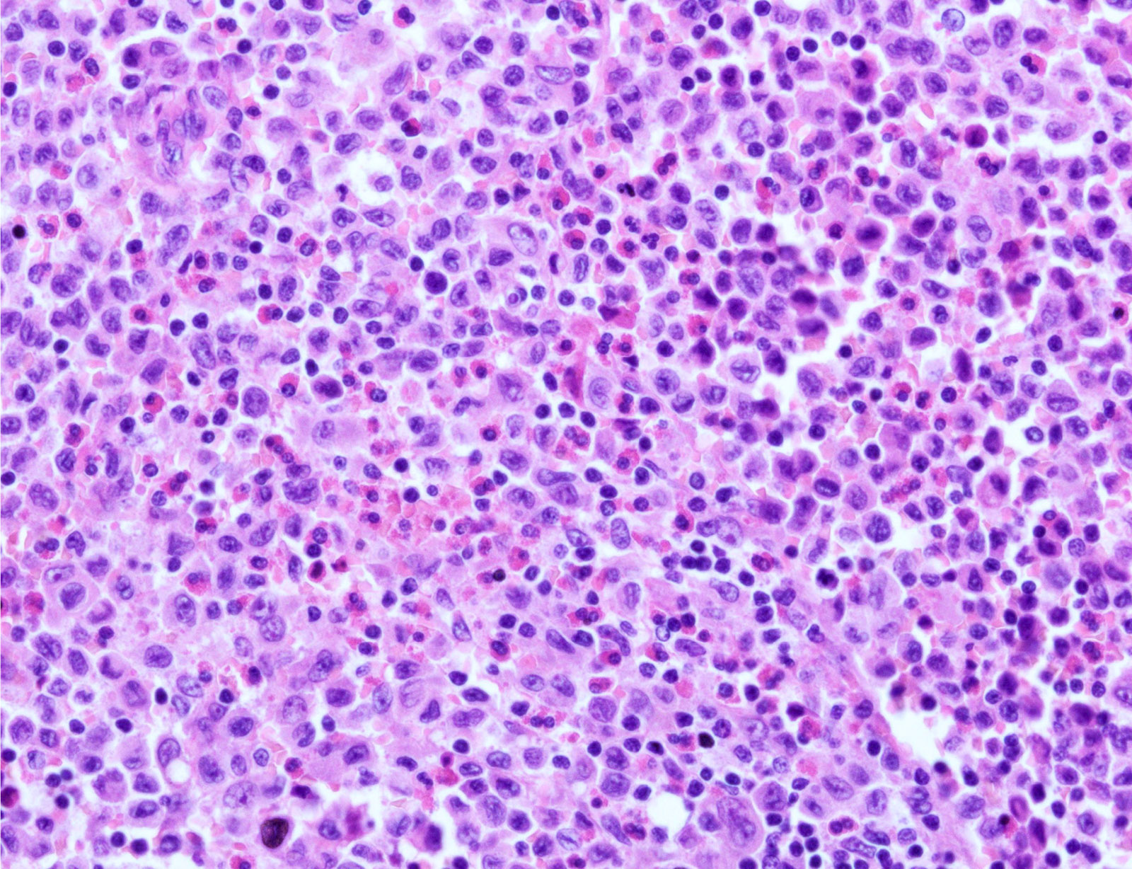 LCH cells and eosinophils