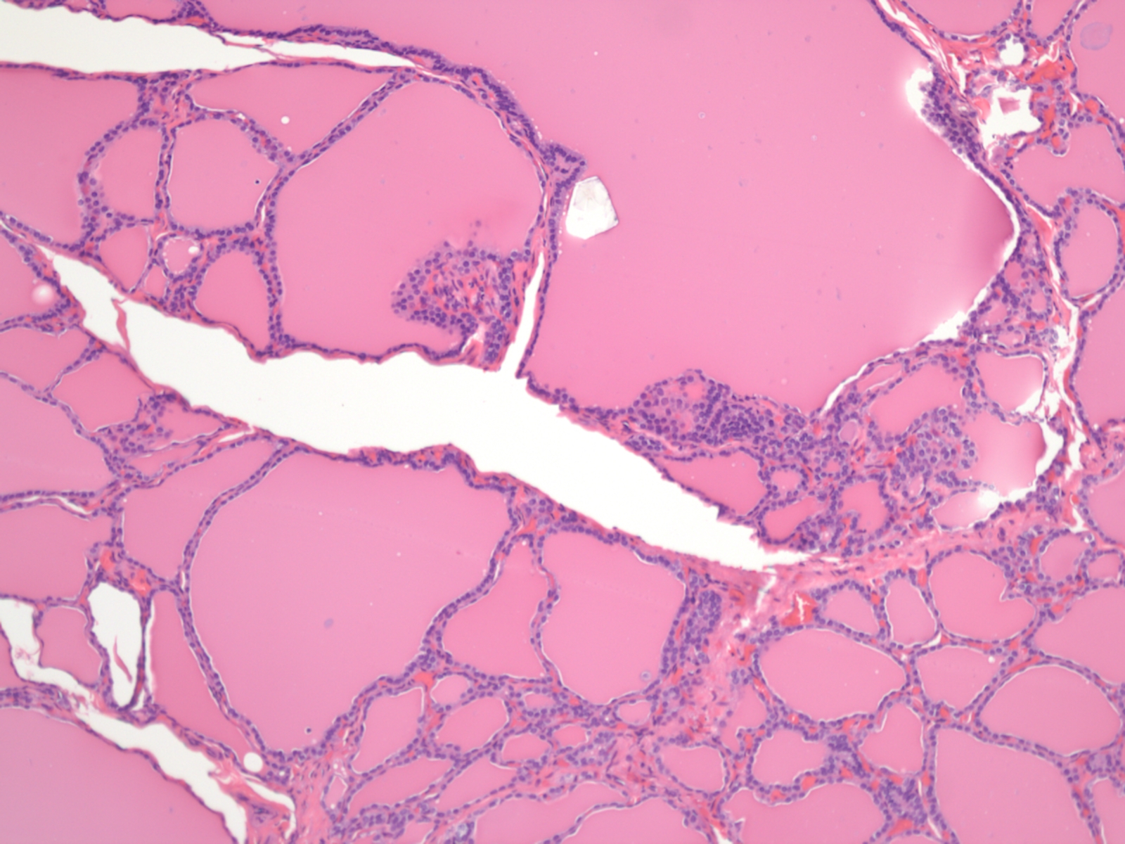 Multinodular Goiter Histology