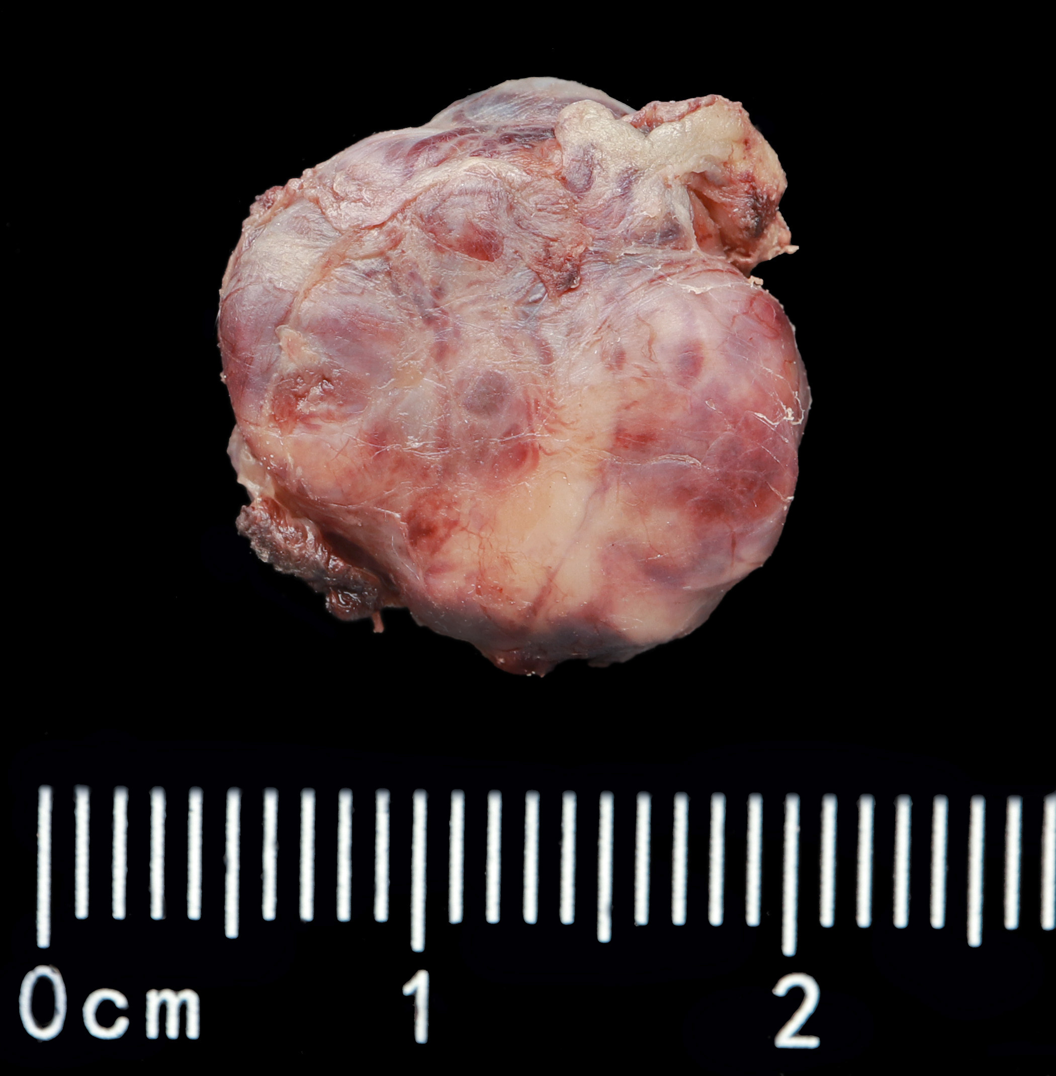 Parathyroid adenoma
