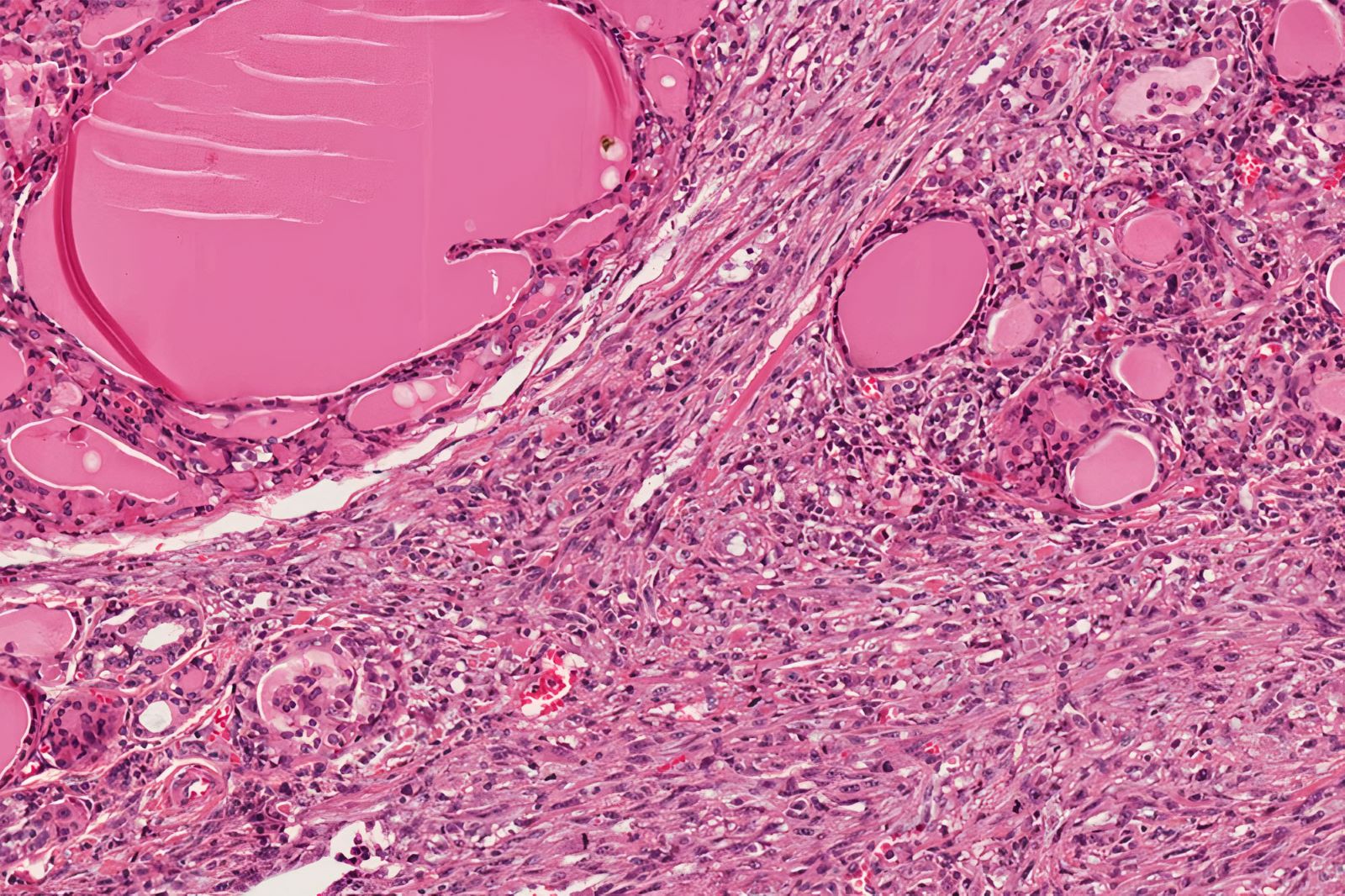 Entrapped thyroid follicles