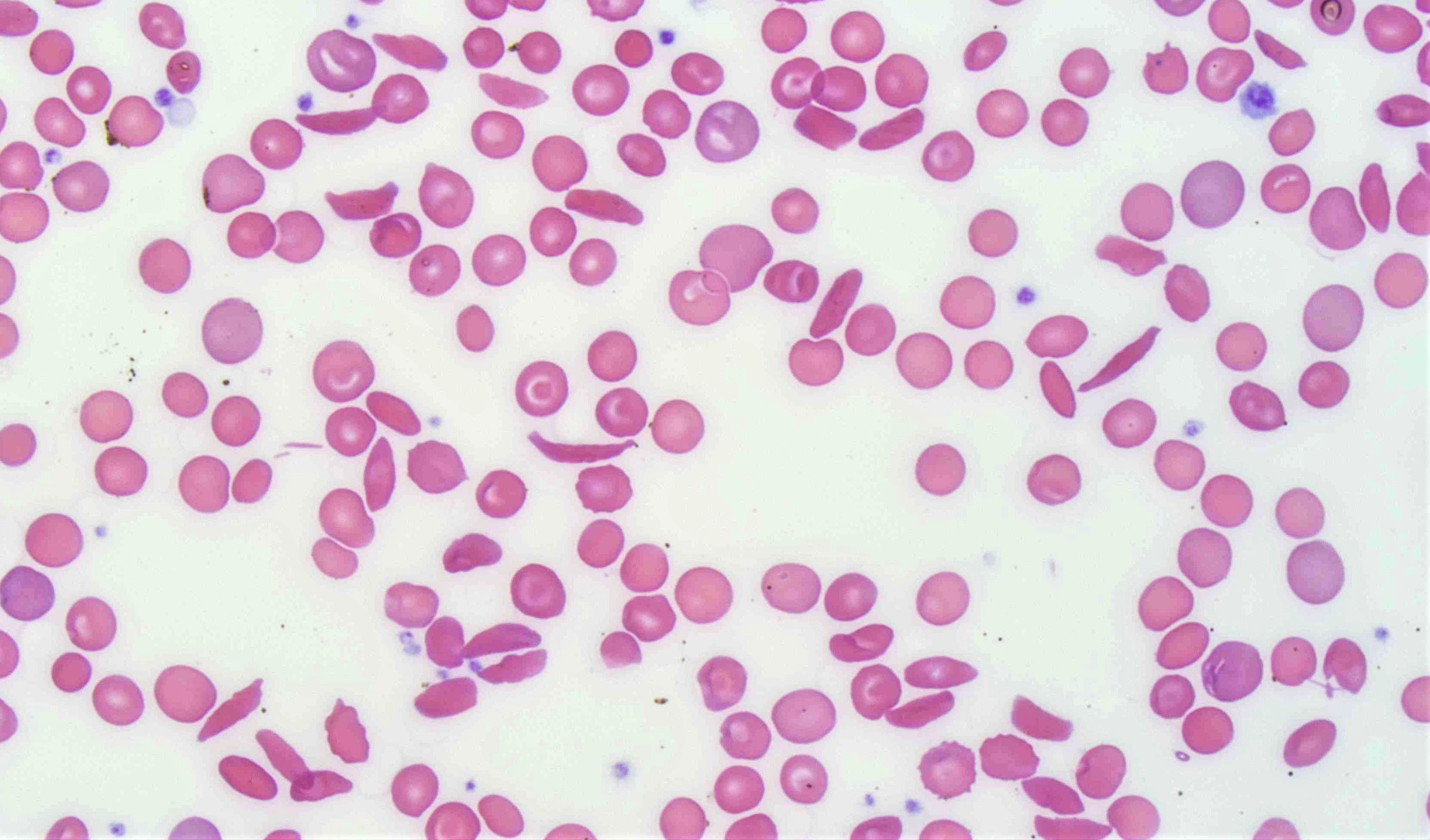Sickle cell blood smear