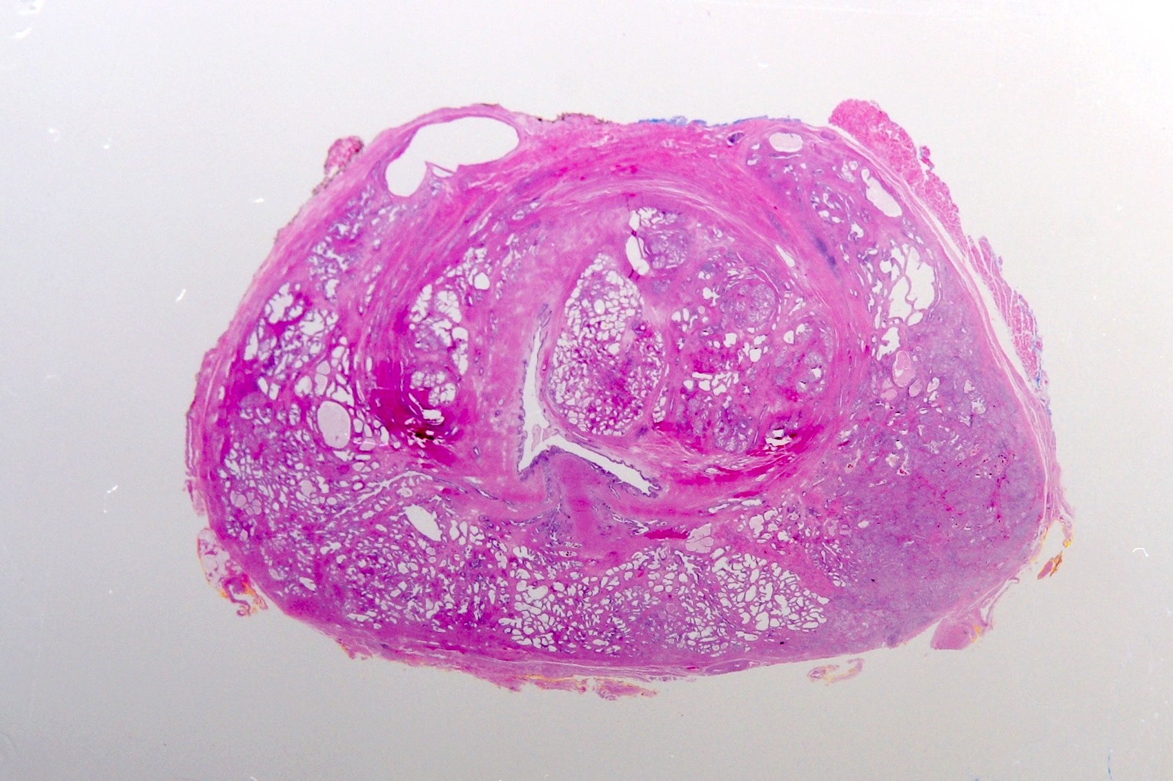 Prostate, cross section with prostatic urethra